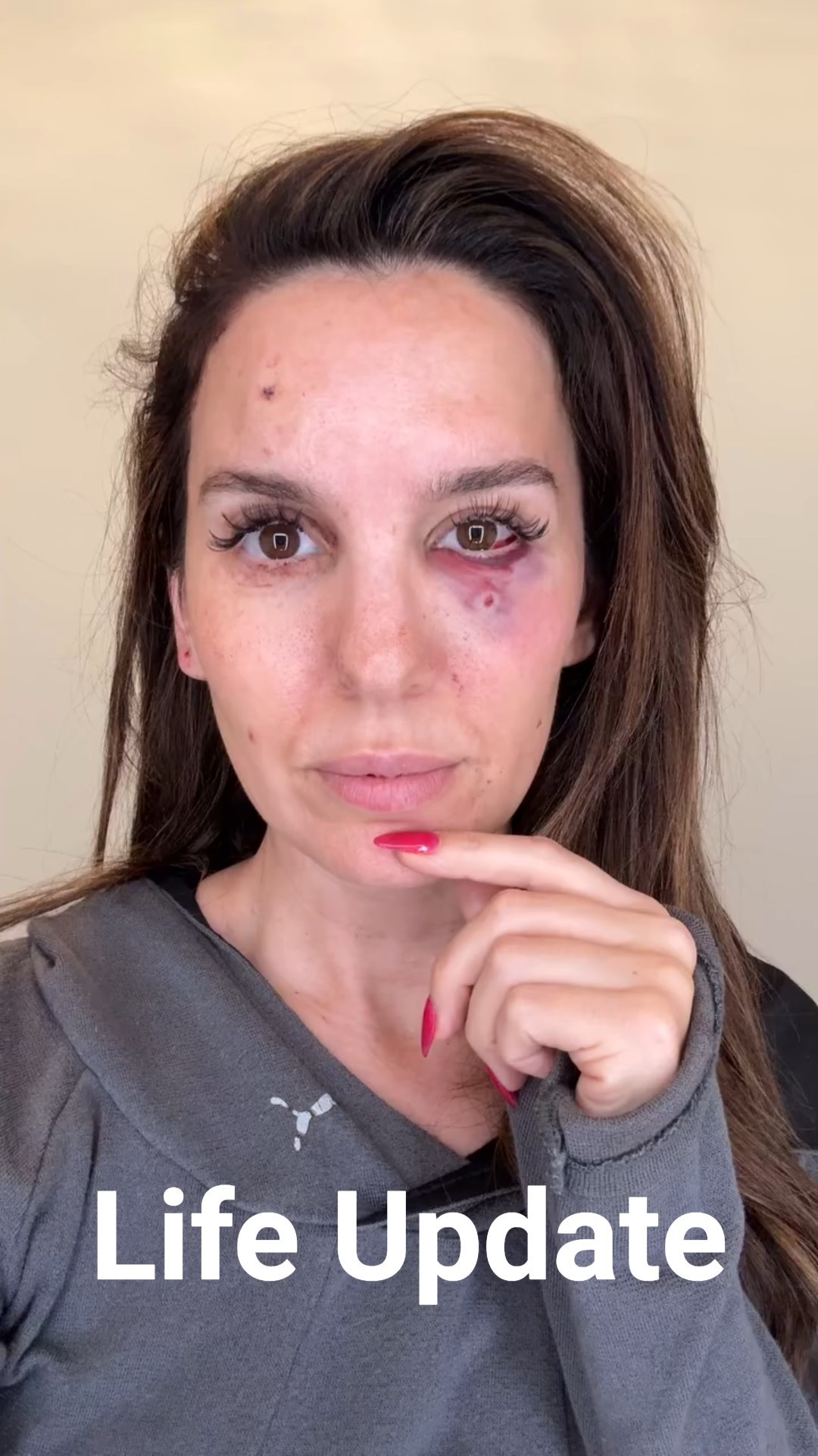 February 7th was my husband’s birthday and I took him to shoot clay pigeons as a present. There was another party with us and they unsafely fired in the wrong direction and shot me in the face. My husband immediately sprung into action, assessed me, and rushed me to the hospital. I was hit in 5 places, one was less than 1mm from blinding me and if it didn’t graze my cheekbone I would be dead. 

Unfortunately a fragment got lodged behind my eye and it is too risky to remove surgically at this time. Doctors will continue to monitor me (I can see normally at the moment).

With everything that happened, all I can think about is how grateful I am to be alive. I love my daughters, husband, family, and friends so much. I saw my life flash before my eyes and I’m telling you, hug the people around you every chance you can. Life can change in an instant. 🙏 

#LTKWatchNow