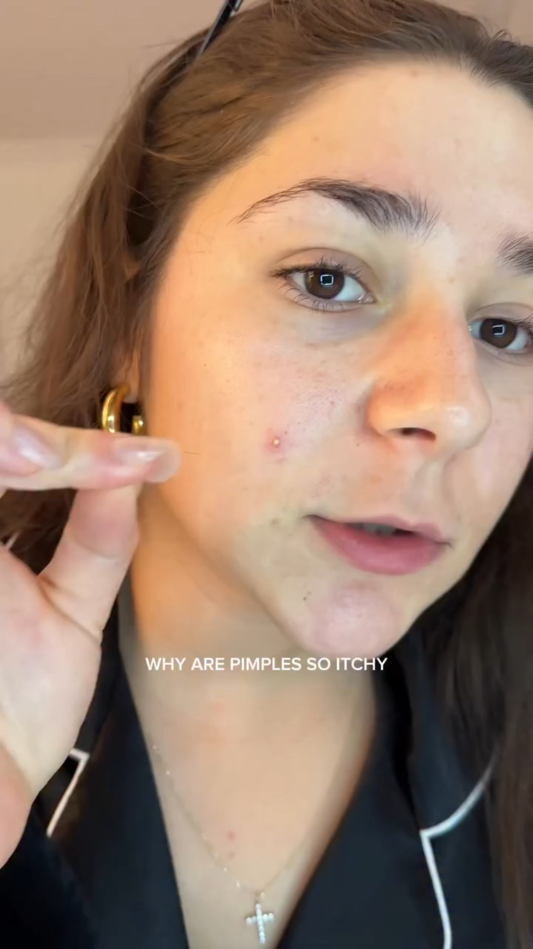 1) why does acne itch and 2) why do I fall going UP the steps like be fr?! @chatgpt was not giving me what I needed to hear please lmk what yall say🤝

@peach_slices 

#acneproneskin #acnejourney #pimplepatches #pimplepatch #pimplepopping
