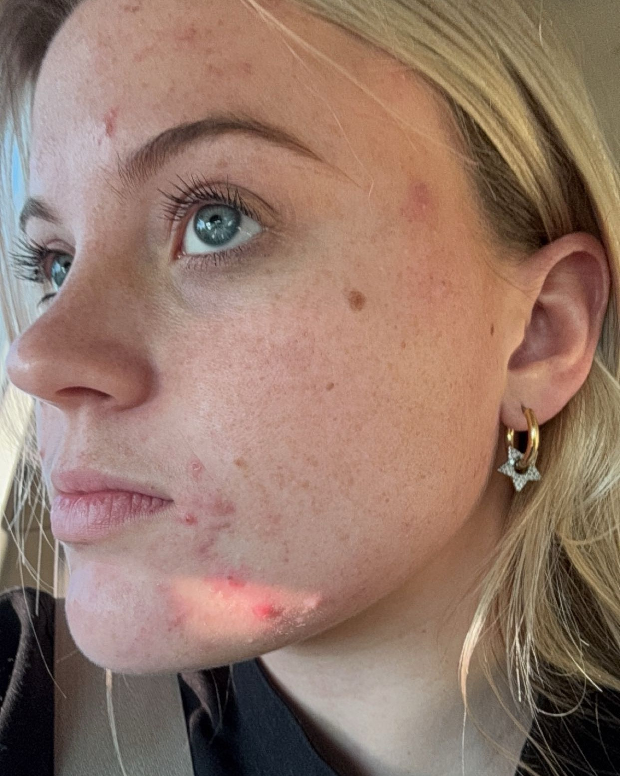 Before -> after
ONE WEEK of using The Ordinary skincare! Linking all the products I use! 
- I have acne prone, oily skin 

#LTKBeauty #LTKFindsUnder50