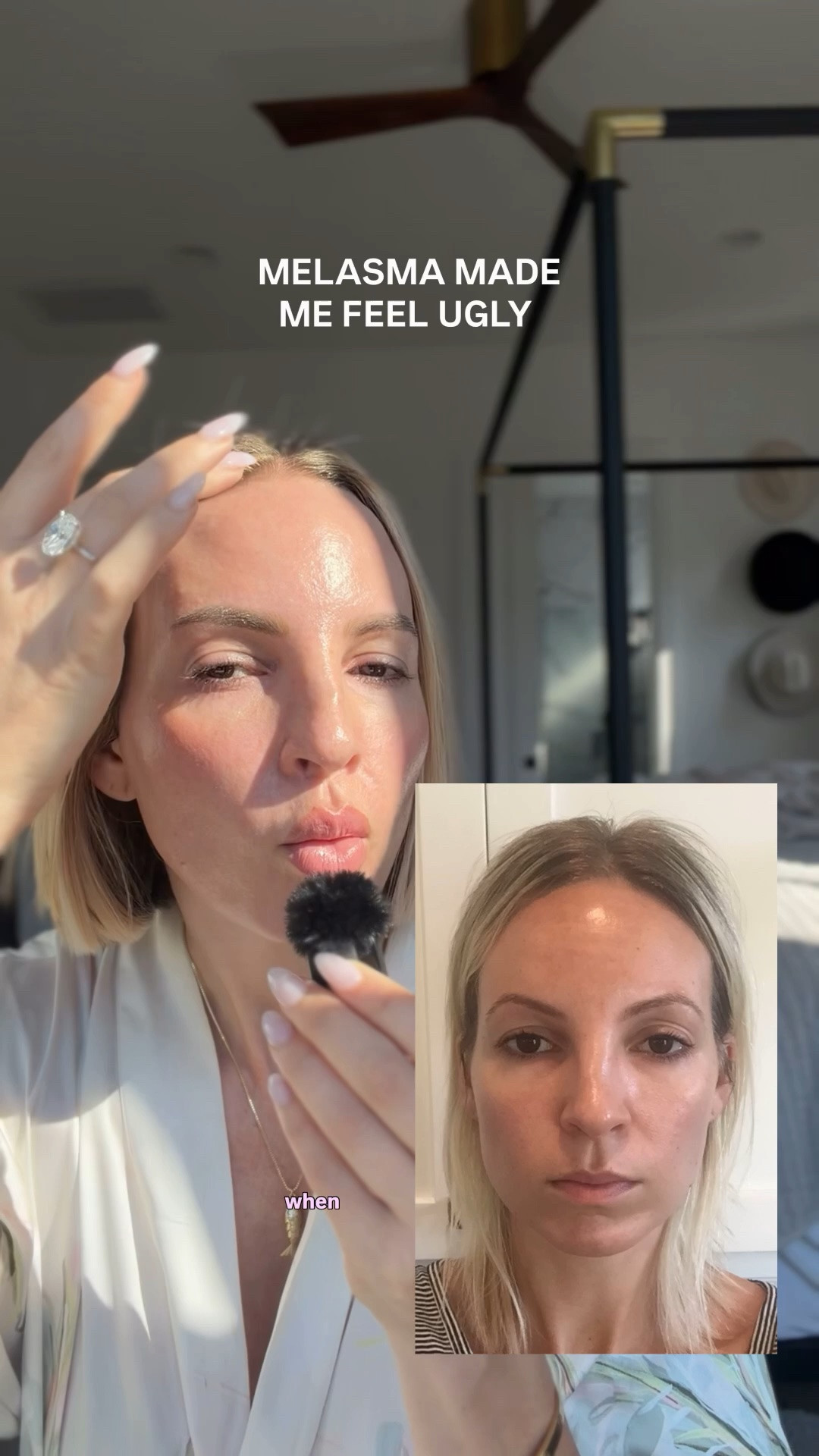 When I had melasma, I felt like it was the first thing I would see every time I looked in the mirror. I felt ugly. If you’re struggling with this too, I get it.

Here’s exactly what helped me get rid of it for good:
1. Obagi Nu Derm Clear RX. This cream helped my melasma the most. You need a script for it though. I mixed mine in my tretinoin. It gives you the glowiest skin. I also linked one you don’t need a script for, but it takes a bit longer to start working
2. Tinted mineral sunscreen- the tint contains iron oxides, which provide significantly better protection against visible light, especially the wavelengths that can trigger pigmentation in melasma-prone skin.
3. Reapplied my SPF. Most people don’t use enough sunscreen and don’t reapply. I linked the sunscreen powder I use on top of my makeup. ￼
3. Wore hats—but not just any hat. I learned that heat can be a trigger for melasma. I avoided tight hats that trapped heat against my forehead and looked for breathable options whenever possible. (Linked some of my breathable favorites)￼
4. Vitamin C every morning. This became part of my daily routine and helped support my overall pigment-fighting routine.
5. Niacinamide helped support my overall pigment-fighting routine. It can help reduce the transfer of pigment within the skin. I use every morning. ￼
7. Tretinoin several nights a week. This helped with cell turnover and was a huge part of my long-term skin strategy.
8. Regular chemical peels. Chemical peels helped speed up the fading process and kept my skin looking more even. I personally loved the VI Peel.
9. I paid attention to heat. This was a big one. For some people, melasma isn’t just triggered by UV exposure. Heat can play a role too, which is why I became much more mindful of prolonged heat exposure. (now that I have my melasma under control, I can do things like hot Pilates and hot yoga, but in the beginning, I needed to be super careful)￼

#LTKBeauty #LTKstorytime #LTKselfcare