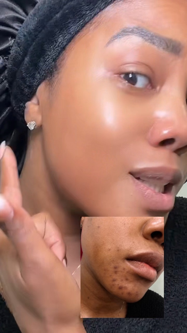 I swear by this system!! I use it nightly and it has done wonders for my dark spots and hyperpigmentation!! 🔥🔥🔥🔥

#LTKgrwm #LTKselfcare #LTKBeauty