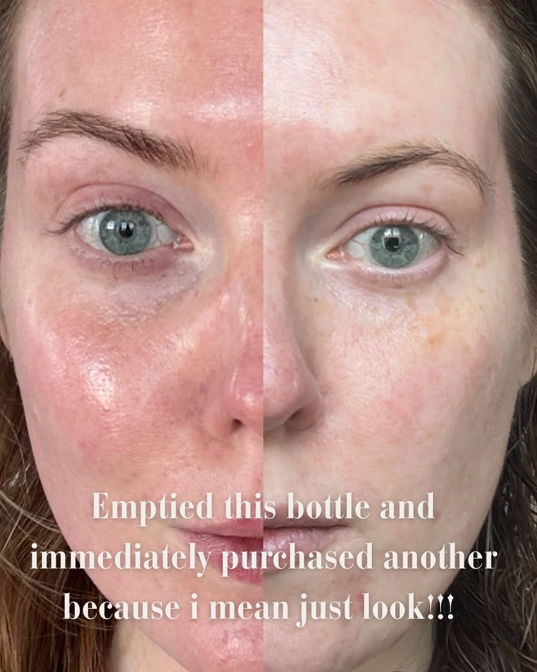 Emptied the bottle and immediately repurchased… because just LOOK.
This is the Experiment Beauty Exosome Serum* and it’s one of the rare products that made a visible difference in my skin’s texture, redness, and overall calm.

I noticed smoother skin, less irritation, and that healthy, even glow that usually takes months to show up — and it held up even through winter dryness. If you’re focused on barrier repair, skin recovery, or getting your skin back to baseline, this one is worth the hype.

Linked in LTK 🤍 Save this if you’re rebuilding your skincare routine with intention.

#LTKbeauty #skincareresults #exosomeskincare #barrierrepair #emptiesreview #sensitiveSkin #beforeandafter #glowyskin 