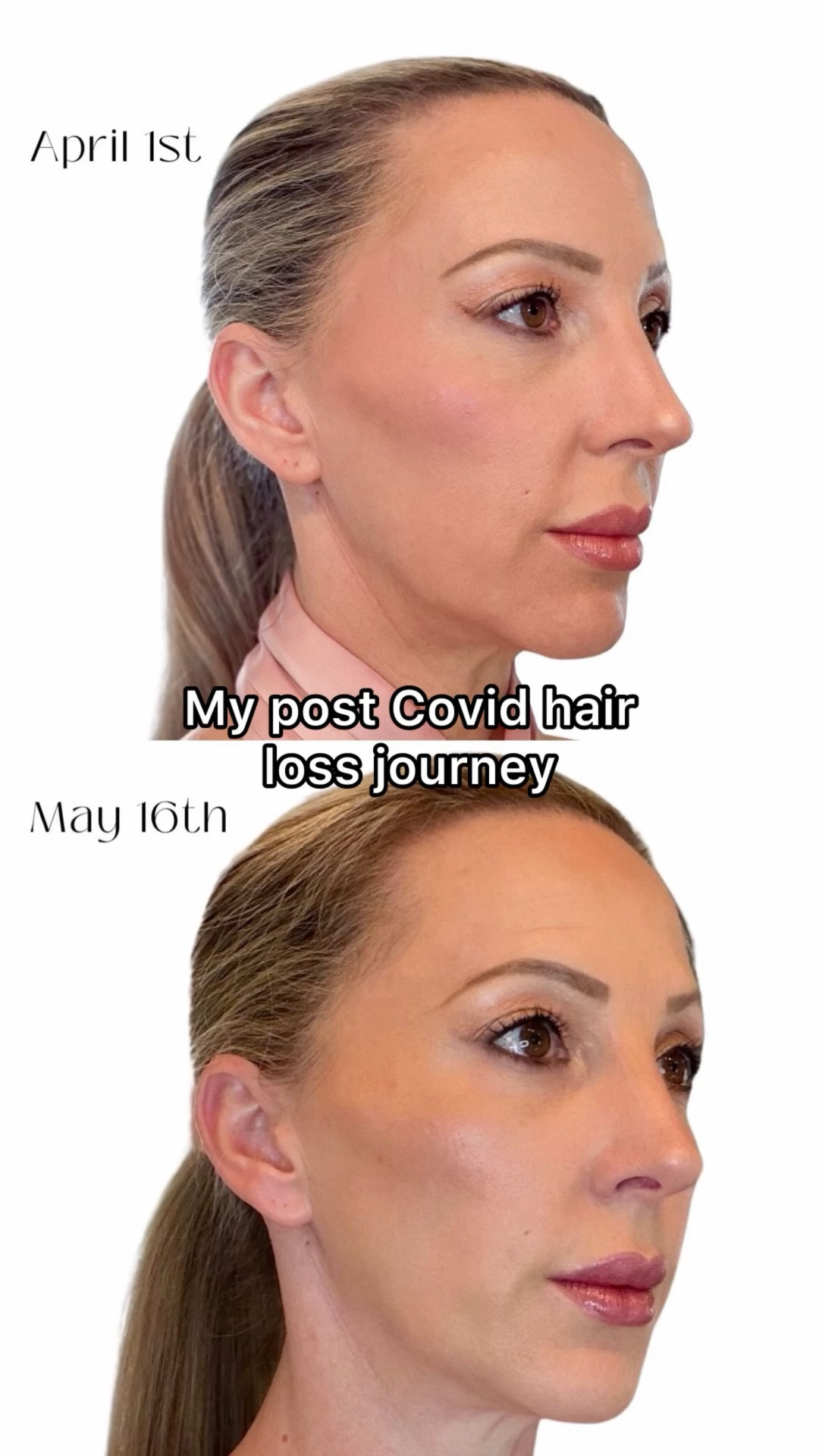 If you’re struggling with hair loss whether thats postpartum, illness, or age you need to try this. As someone whose tried it all @currentbody led red light hair growth helmet has worked so well not just for me but my husbands male pattern baldness too. You do have to be consistent but the fact that we can share it makes it better value and you can use our discount code GLAMOURCB for 10% off. FDA cleared and clinically proven.

#LTKdayinmylife #LTKselfcare