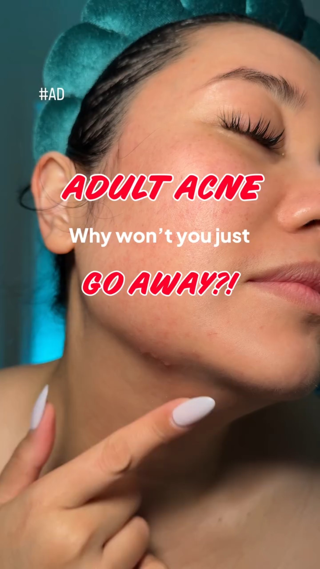 #AD Adult acne is real — especially those stubborn jawline breakouts 😩 If you’re dealing with acne and post-acne marks at the same time, the NEW Neutrogena Evenly Clear Acne Cleanser is a multi-tasking acne solution that treats acne AND visibly fades post-Acne Marks. Visible results in 7 days. Co-designed with dermatologists for clearer, more even-looking skin. Go grab yours today! @neutrogena 

#EvenlyClear #Acne #trending #viral