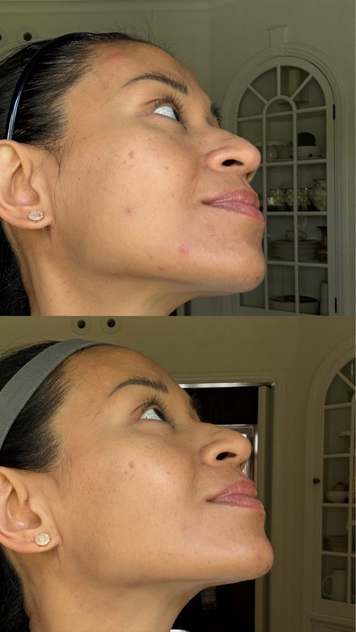 Two months in. A before and after since using my LED multi light therapy mask. I’ve struggled with acne my entire life and am absolutely blown away by the results! Besides the mask, my skin routine has not changed and I haven’t seen my skin laser tech this entire year. 

Because of my darker skin, I have to be careful with hyperpigmentation with red and blue light which is why the multi light is perfect. It has red, blue, yellow and green light with 5 treatment modes. I use 5 days a week rotating the modes and my skin has never looked better! They gave me a code for you to try. Code: PATTIWAGNER will get you 10% off!

#LTKselfcare #LTKBeauty