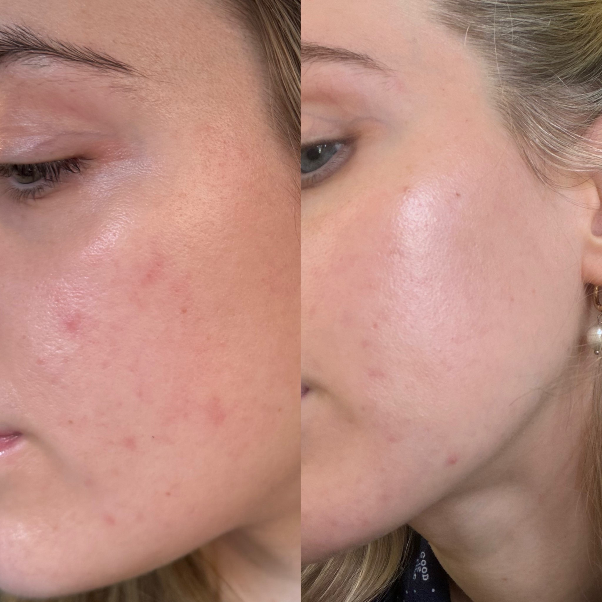 78% improvement in firmness and elasticity in 6 days! Here are my results first photo is March 5th, second is today! 

#LTKselfcare #LTKmorningroutine #LTKdayinmylife