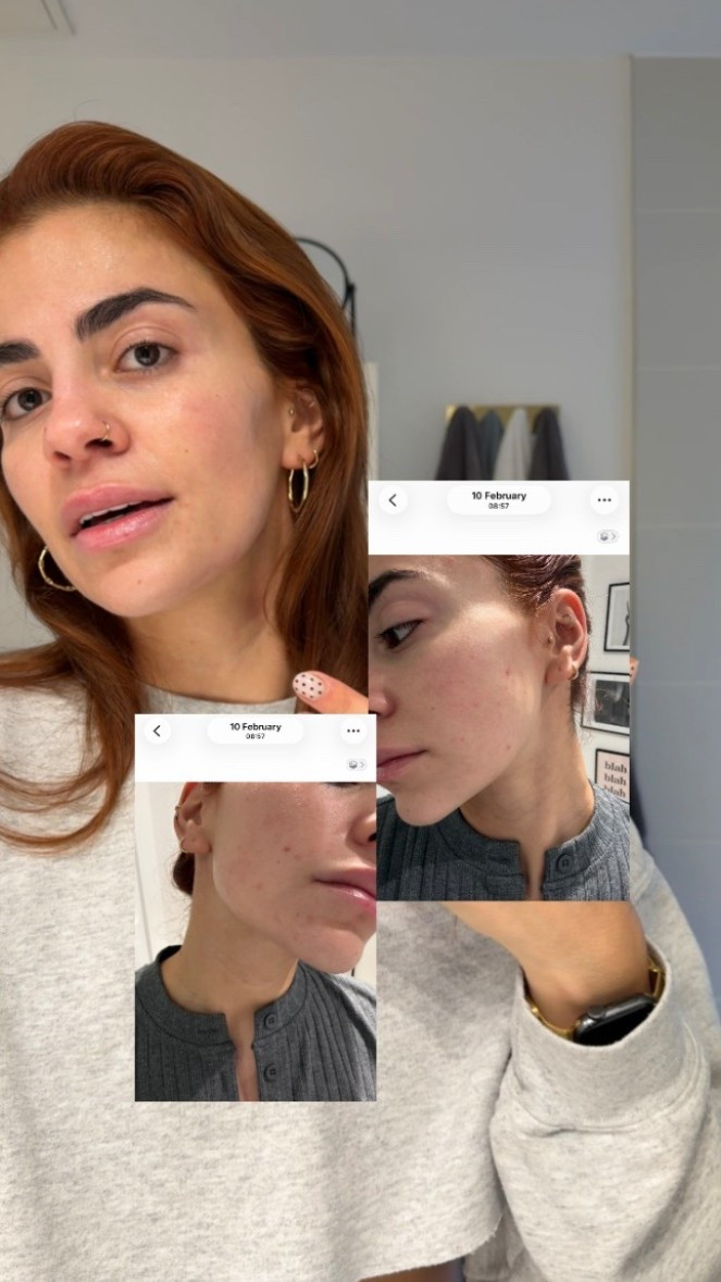 My skincare routine during a perioral dermatitis flare up! It’s worked wonders!!! 

Erborian Centella Red, Rhode, Beauty of Joseon

#LTKuk #LTKbeauty #LTKeurope