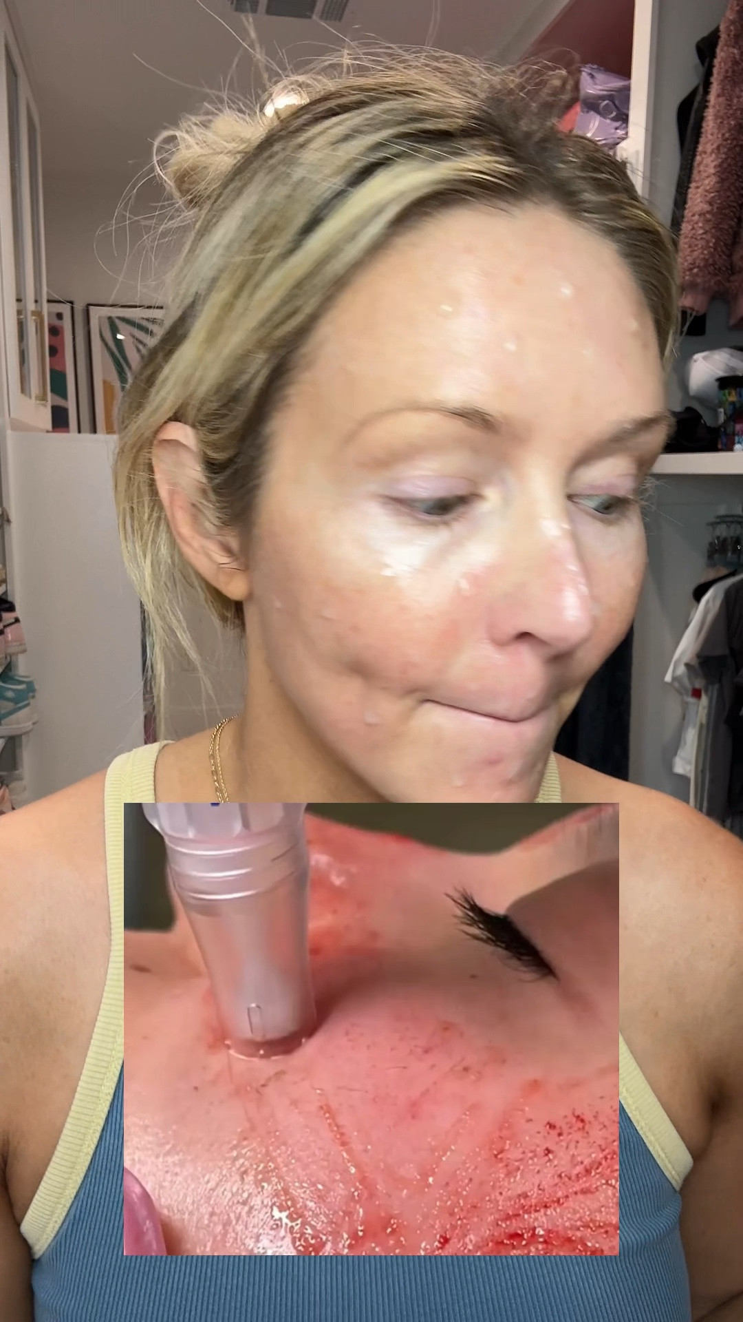 Microneedling in a bottle! Boost collagen, reduce inflammation, wrinkles and acne scarring. Safe for acne prone skin  

#LTKOver40 #LTKBeauty #LTKselfcare