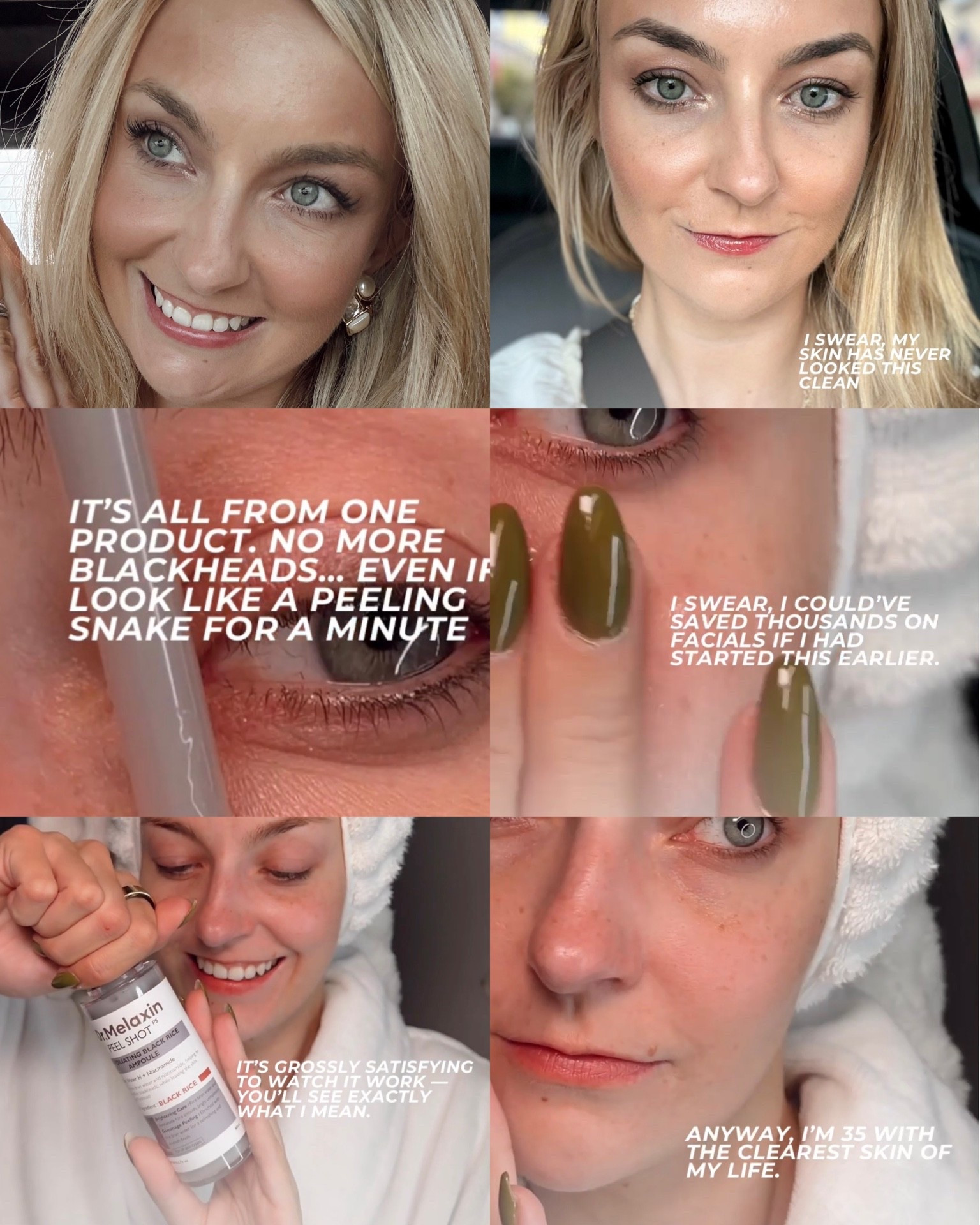 can’t believe I’m saying this…but this peel shot from @dr.melaxin_global basically replaced all my facials 😭
Like actually saved me thousands.
My husband tried it once and now he’s obsessed too — we’re both peeling like snakes 🐍
Dead skin gone, glow unlocked, pores who?
It’s gross but it’s satisfying.

#peelshot #drmelaxin #drmelaxinpeelshot #kbeauty #exfoliation #blackhead #amazonbeauty #deadskinremoval #smoothskin 

#LTKFindsUnder50 #LTKBeauty #LTKGiftGuide