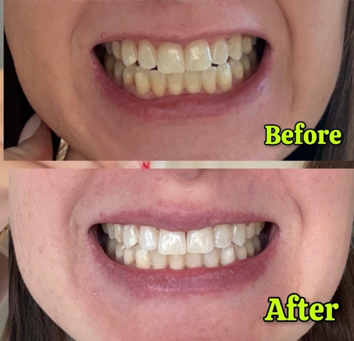 On sale for prime day! This is a great deal and the only teeth whitening system that has actually had results for me! Highly rec!