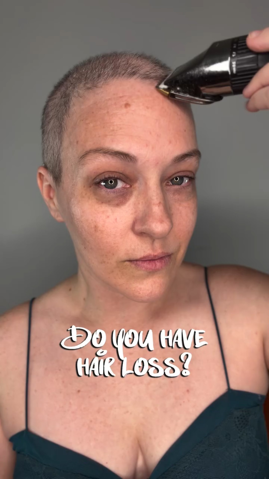 Do you have hair loss? This is your sign to own your story. However you want it to look. You decide not your hair 💇🏻‍♀️ If you love what hair you have left and it makes you feel good holding on to it then do what makes you feel best. 

This is what makes me feel best and I know there are some women out there that feel the same about regrowth and the acceptance process. For me personally I’ve processed the part where it’s gone and it will never come back the way it was. Why stare at hair that makes you feel poorly about yourself when you could feel better without it? I know not everyone is there and you don’t have to be or ever need to be. This is your journey and your body. 

My wigs fit better, I don’t need scar tape or a wig grip ever and looking in the mirror makes me smile not turn away. Yes, you can. 

#selfimage #confidenceboost #glowup #bald #shavedhead #alopecia #womenshairloss #thinhair #baldspots #regrowth #buzzcut #bravetheshave #yesyoucan #HairLossSupport #hairlosssolutions