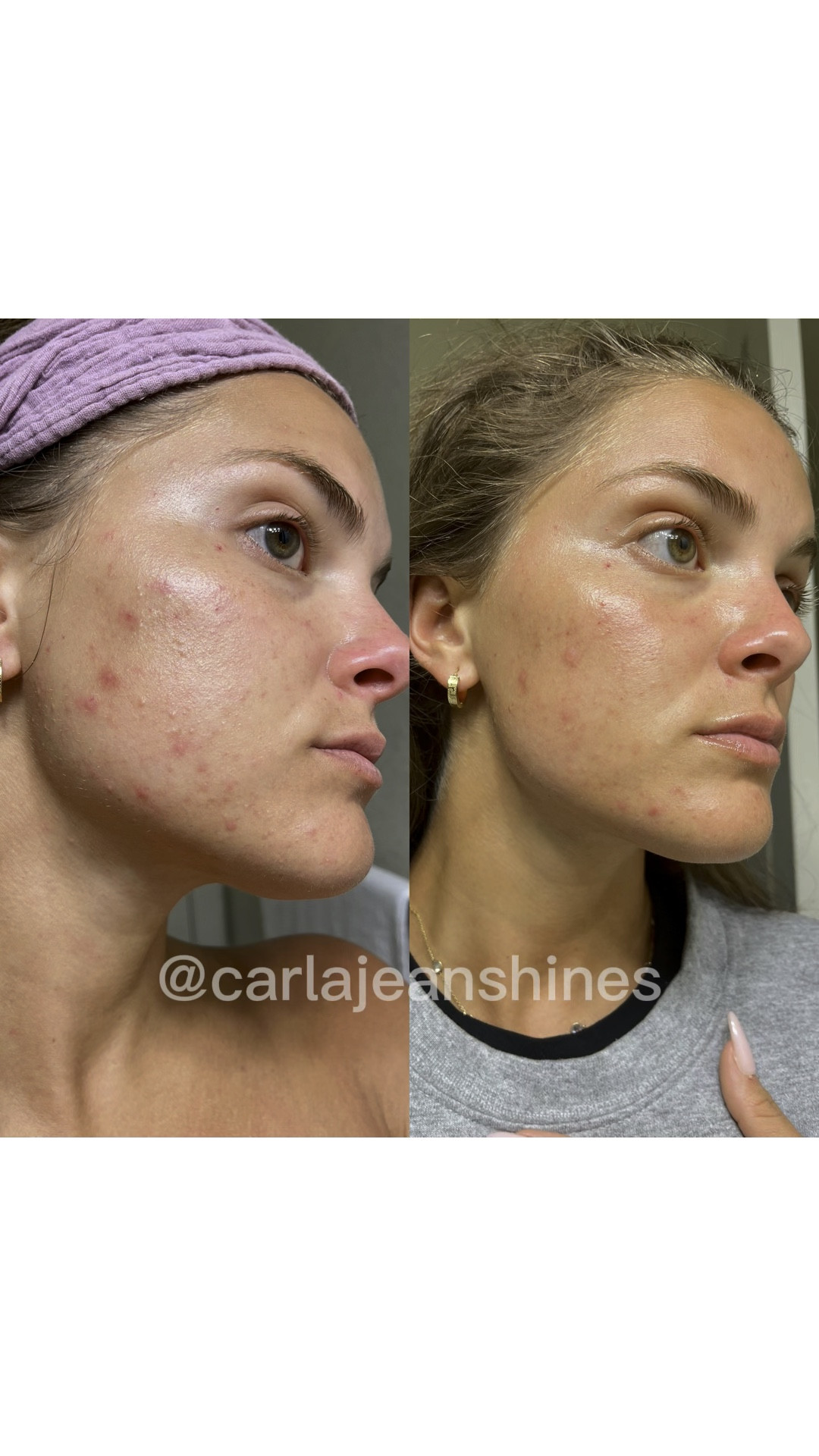 Skin transformation using beauty counter! If you’ve been struggling with some acne and are looking for clean beauty products, try this line! It’s worked wonders for my skin. I have dry skin and this system works well with my skin type.

#LTKbeauty #LTKVideo