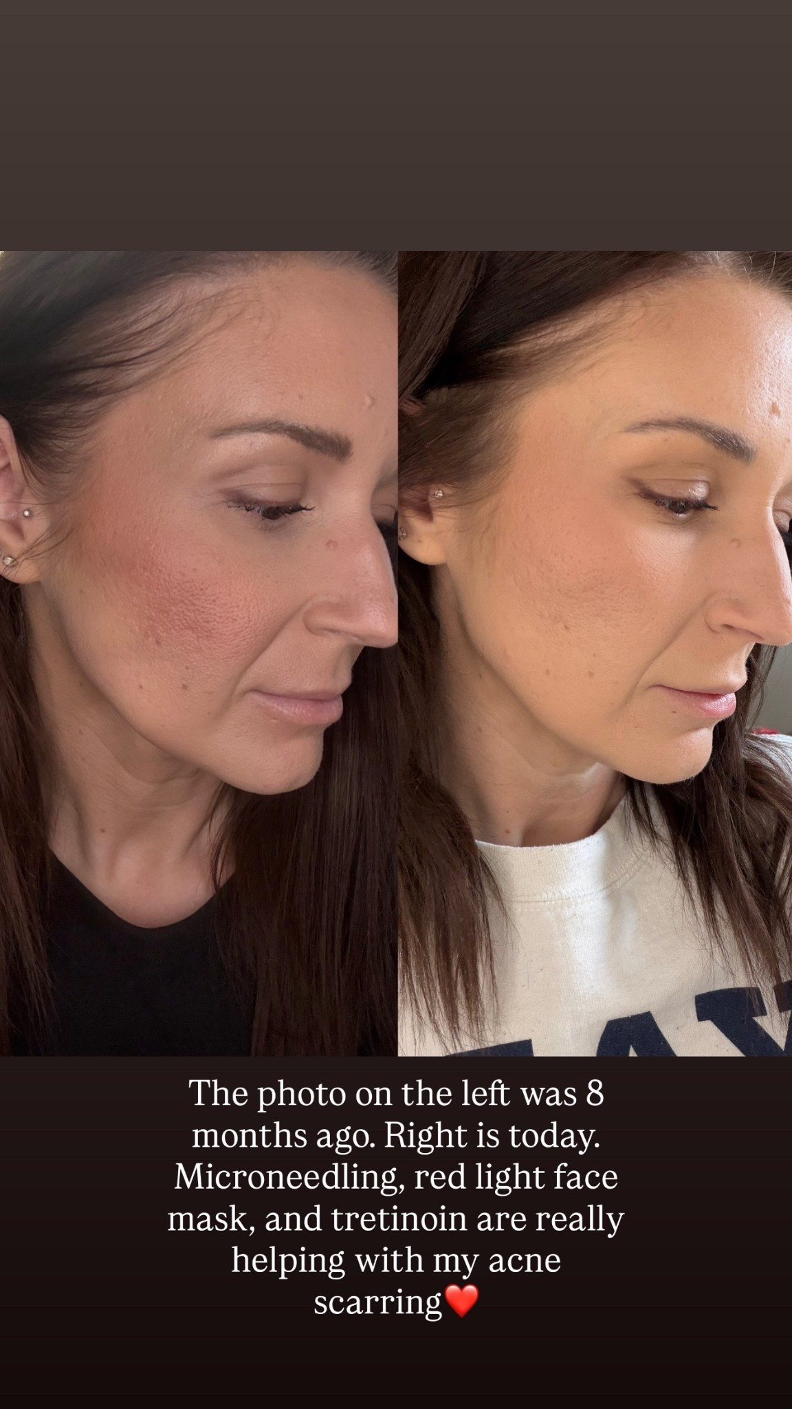 Red light therapy face mask I use 3-5 times a week at least. Only 10 minutes!

#LTKselfcare #LTKBeauty