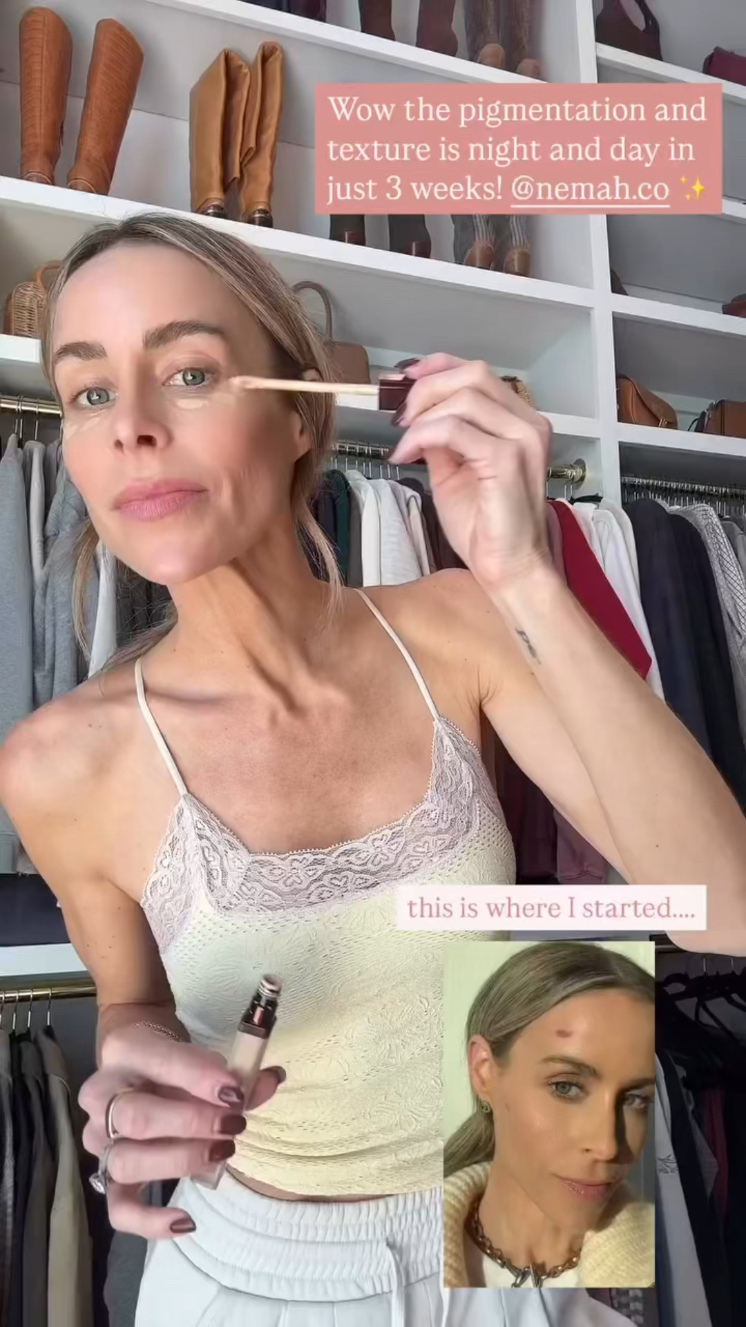 Wow the pigmentation and texture is night and day in just 3 weeks!✨

#LTKWatchNow #LTKBeauty