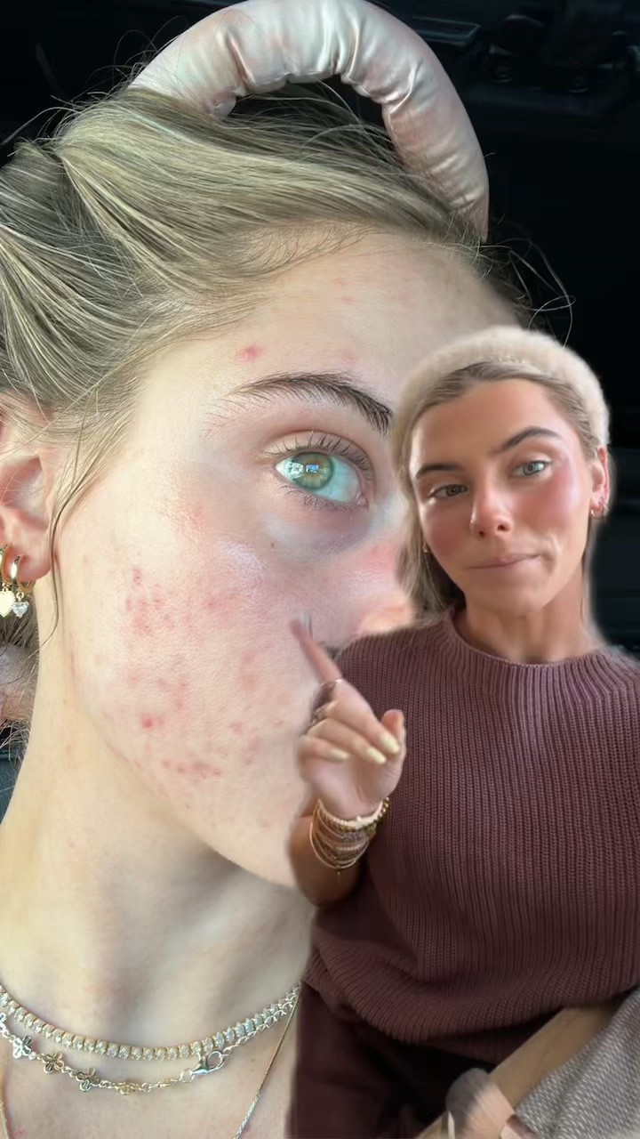 Triclone™ Skin Tech Concealer

A clean, lightweight, long-wearing, non-comedogenic concealer that does more than cover—it visibly blurs, brightens and conceals with medium, buildable coverage that de-puffs after 2 weeks of use.

HausTech Powered™ with 20+ skincare ingredients including our patent-pending Fermented Arnica
@hauslabs @Sephora     @Kohl's 

#LTKgrwm #LTKBeauty #LTKselfcare