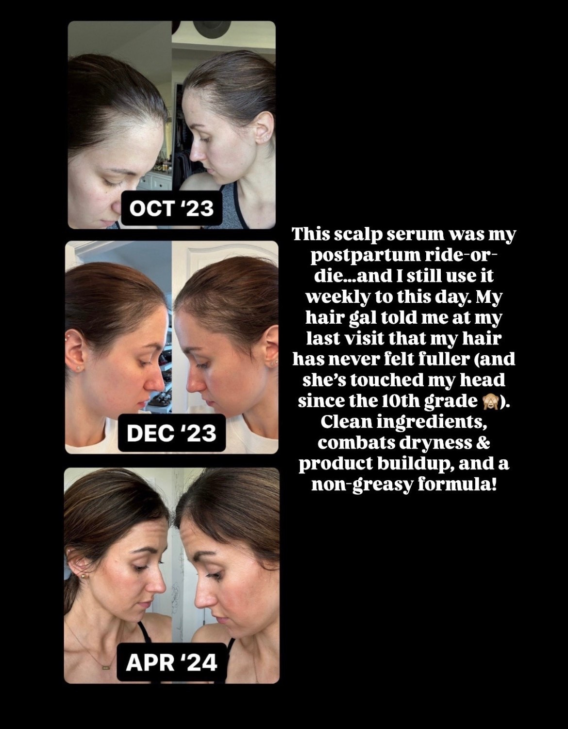 This scalp serum is the BEST for postpartum hair thinning + I use it weekly! 

#LTKmomlife #LTKBaby #LTKBump