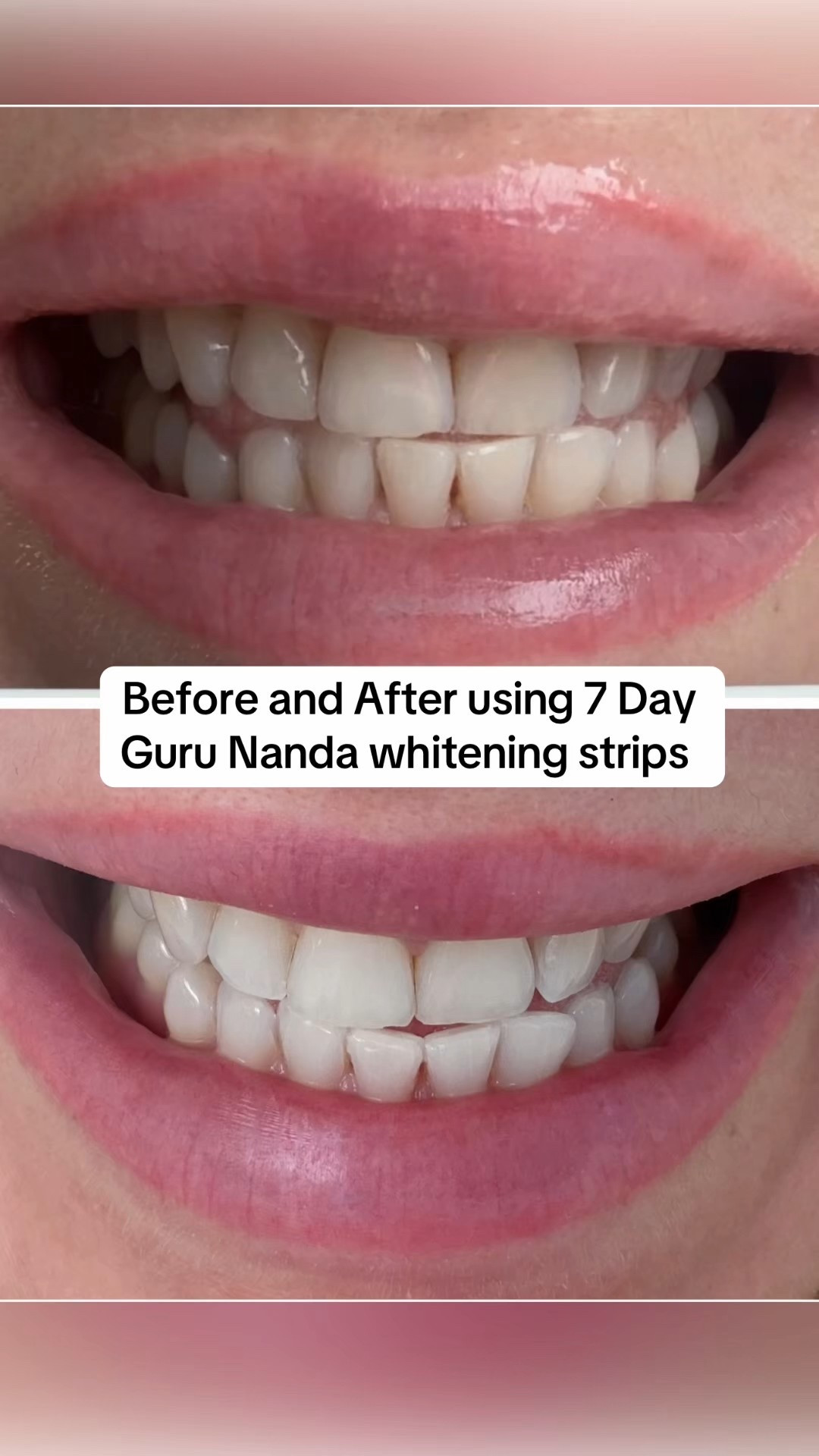 My honest review of Guru Nanda 7 day whitening strips 😁

#LTKBeauty #LTKFindsUnder50 #LTKHome