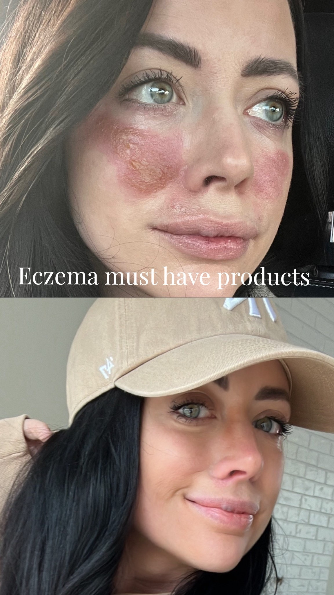 Eczema skincare products that help! 

#LTKbeauty #LTKfitness