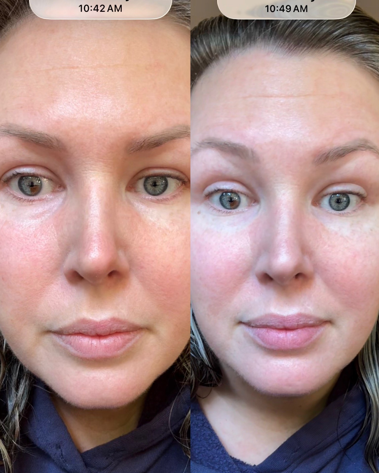 Ok I’m sold 😵 this instant lift eye cream really works guys! Will continue to document it every time I wake up with big ole bags under my eyes!!! This is 7 mins apart!

#LTKmomlife #LTKselfcare #LTKBeauty