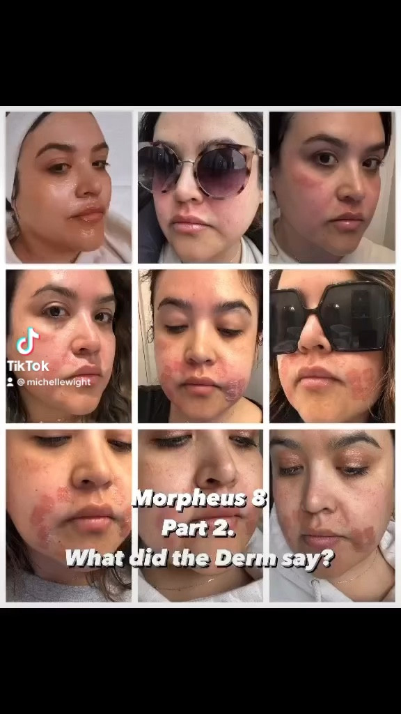 The products that helped heal my skin from this Morpheus burn to completely healed.

#LTKCyberWeek #LTKCyberSaleIE #LTKCyberSaleFR