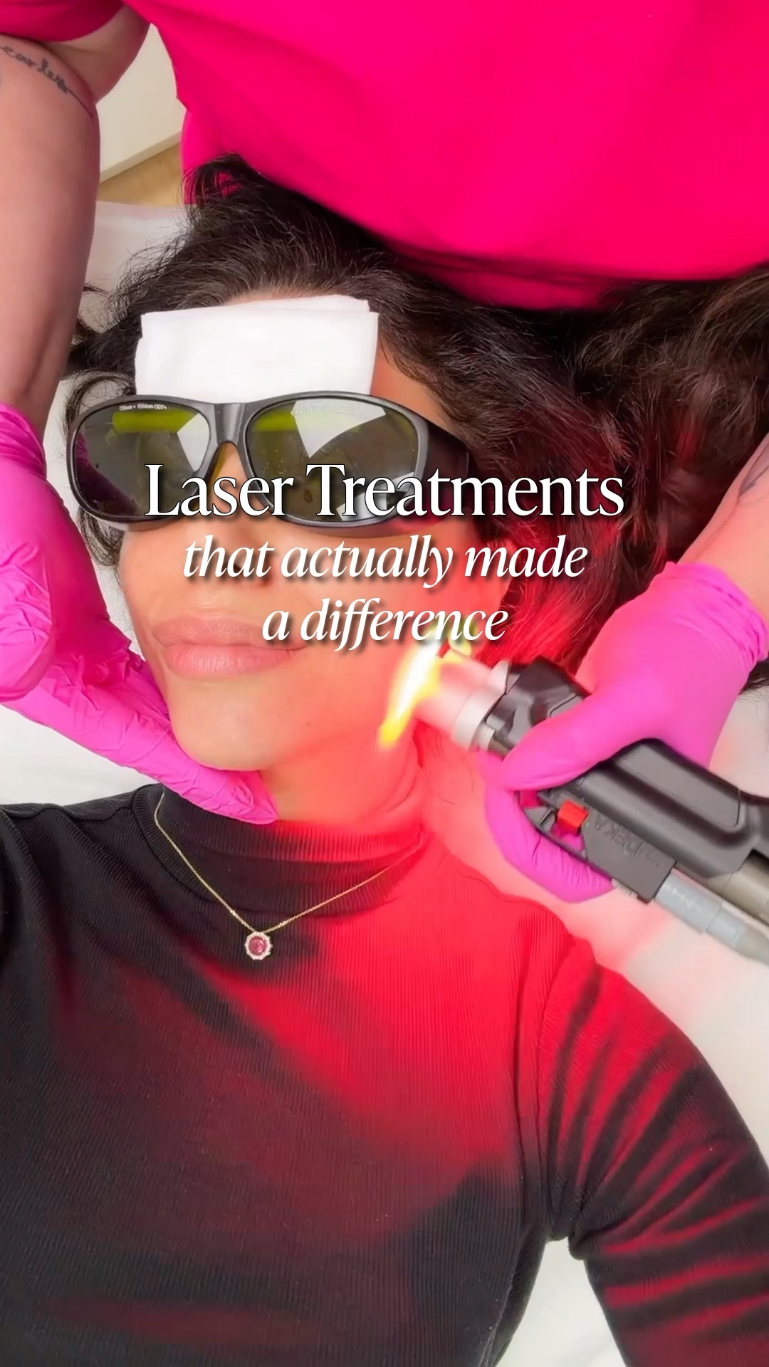 Here’s a breakdown of each laser machine, including downtime, products that help speed recovery and also how much I paid per treatment (pricing varies based on your location, but this is simply to give you a benchmark). 

1️⃣ MOXI is a non-ablative laser that only has about 1 day of downtime. After treatment, you can expect your face to be very red for the rest of the day. For up to 1 week post treatment, your skin will feel like sandpaper (pigment surfaces then falls off, it’s so satisfying lol). You can wear makeup after the 1st day! ❤️‍🩹 For healing, my medical aesthetician recommended Skinceuticals Epidermal Repair cream and I absolutely LOVE it. It’s the only skin product I apply for up to 1 week after treatment. It also comes in handy if my skin is having other issues. 💸 I paid $750/treatment (ask about bundles!) I did 3 treatments because I loved it so much (one of them I had them mix in BBL laser too).  📍 (Northshore Chicago) I did my treatment at the Skin Lounge in Northfield with Kara. 

2️⃣ Painless Hair Removal. As someone who has been doing laser hair removal for 15 years, I am still in shock that a painless treatment now exists. This is one treatment that usually does hurt and unfortunately requires lifetime touch-ups. Look for a MedSpa near you that offers this!! It actually felt soothing 🤭👌 💸 I paid $150 per session just for the face. I’ve done my full body years ago but don’t remember pricing sorry! Everywhere varies and it really depends on the body parts you’re doing. 

3️⃣ Q-Switch for tattoo removal. As someone who spent 2 entire years doing the most excruciating treatments that did not work, I was very pleased to find this laser treatment that worked so well after just 1 treatment. They also numbed it for me, so make sure you go somewhere that has the Q-switch AND numbs you. Very important!!! I paid ~$550 per treatment (they based on how much time it would take). 📍 I went to Advanced Dermatology in Glencoe. ❤️‍🩹 I used Bacitracin and these special bandages that did not budge for days. Downtime is honestly not fun ~1 week, but so worth it 👌💫 xx