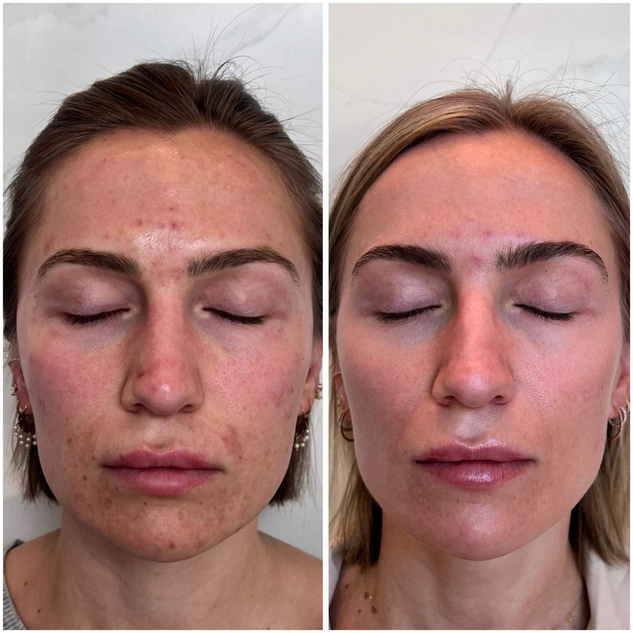 List of all the skincare products that got me this insane transformation in just 3 months! Good bye to hyperpigmentation! I included some travel sized options as well.
Here is the order in which I used them:
AM
1. Exfoliating cleanser
2. Exfoliating polish
3. Calming toner
4. Illuminating AOX serum 
5. Pigment control crème (titrate up as your skin adjusts - this is a prescription product)
6. Sunscreen

PM
1. Exfoliating cleaner 
2. Daily power defense
3. Hydrating crème or Atobarrier moisturiser 
4. Pigment control + blending crème (this is a prescription product)
5. Tretinoin .05% (this is a prescription product)
On the days or nights I did not use the pigment control creams I would use the growth factor serum 🤍 Hope this helps!


#LTKBeauty #LTKFindsUnder100 #LTKTravel