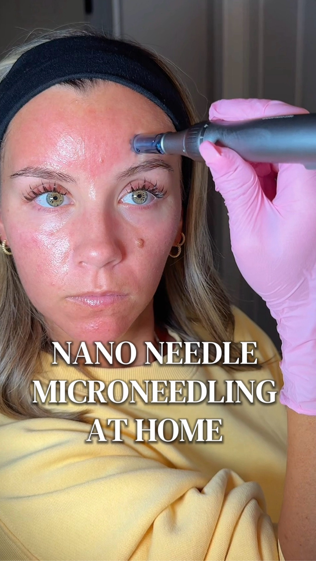 Nano Needling is the perfect intro to Microneedling 💉 here’s everything you need to do it at home on a budget too! @Prequel Skin  

#LTKU #LTKstorytime #LTKBeauty