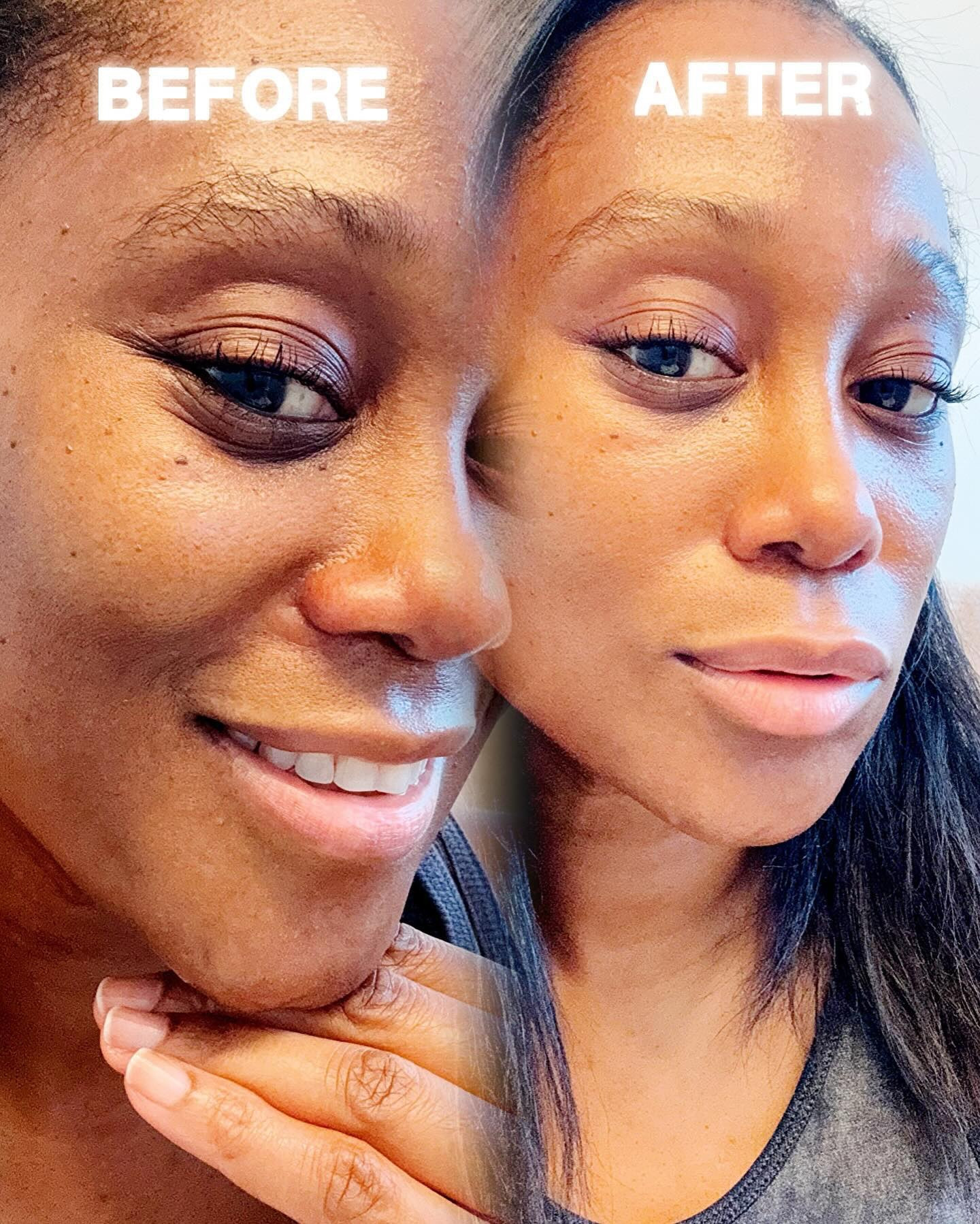 I was hesitant about trying at-home dermaplaning, but the @michaeltoddbeauty SonicSmooth made it so easy. After just one use, my skin felt incredibly smooth and soft, with no sensitivity afterward. It’s officially a new staple in my routine. 💆🏾‍♀️

Comment “smooth” to get the link! 🫶🏽

#MichaelToddBeauty #SonicSmooth #DermaplaningAtHome #SkincareRoutine #SmoothSkinGoals #BeautyEssentials #GlowingSkin #AtHomeExfoliation #SoftSkin #SelfCare #BeautyTools #SkincareAddict #HealthySkin #RadiantComplexion #BeautyGameChanger #SkinCareRoutine
