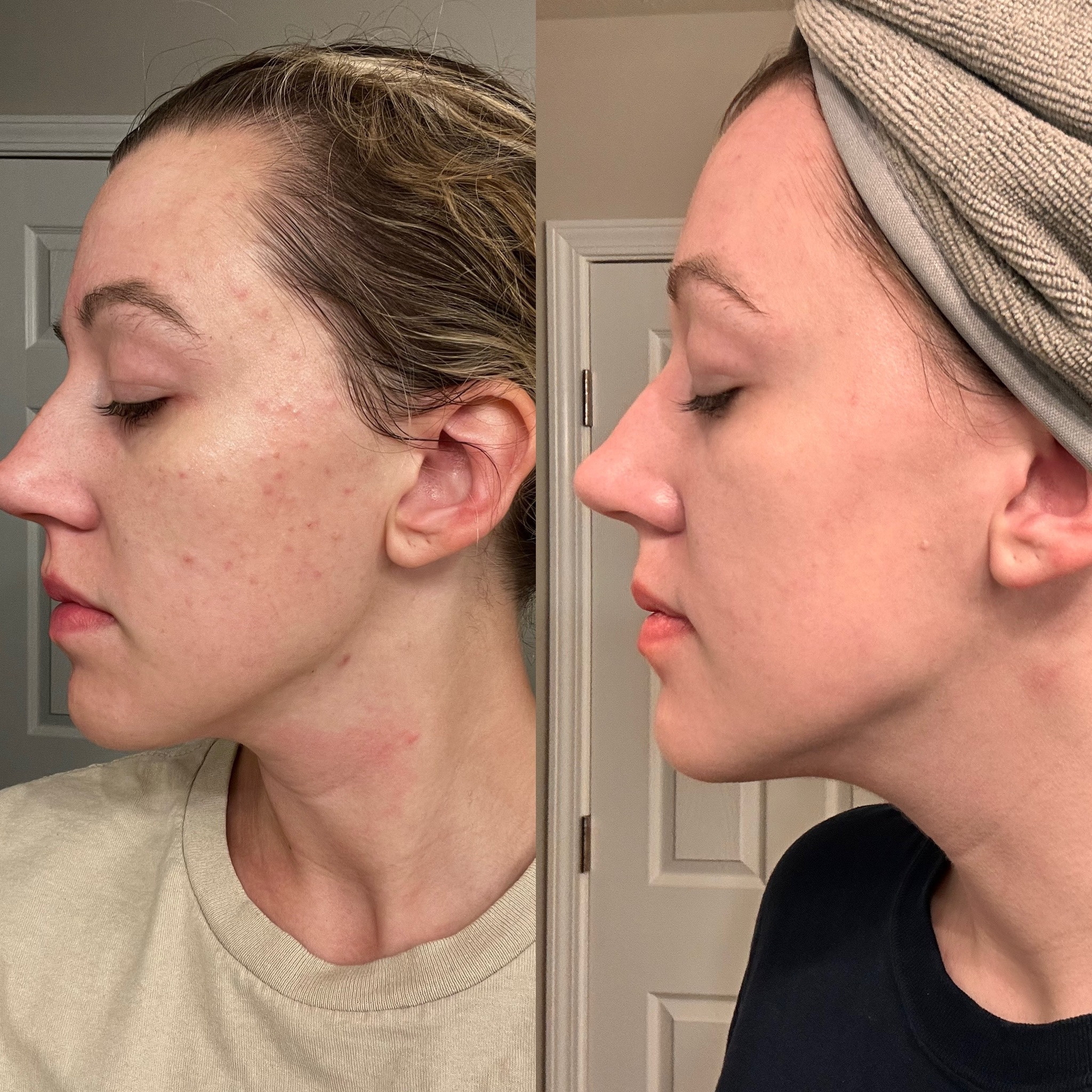 I changed my skin in 3 months with a few products that cost less than most other products I’ve spent money on!#skincare #beauty

Night: 
- Wash #1 with Eminence cleanser and fizzfoliant (mix powder with cleanser)
- Wash #2 with only the cleanser
- Use clean reusable cotton round and apply BHA all over face, every other night
- Soak your face with moisturizer
- Apply lip mask

Morning:
- Wash #1 with Eminence cleanser only
- Apply Vitamin C serum to dry face, allow to completely dry
- Apply moisturizer to face, ears and neck, allow to completely soak in before apply makeup

*if you notice your skin drying out, cut back on how often you use the BHA, or use the La Roche Posay Cicaplast Balm after you moisturize at night for even more restoration to your moisture barrier!

#LTKbeauty