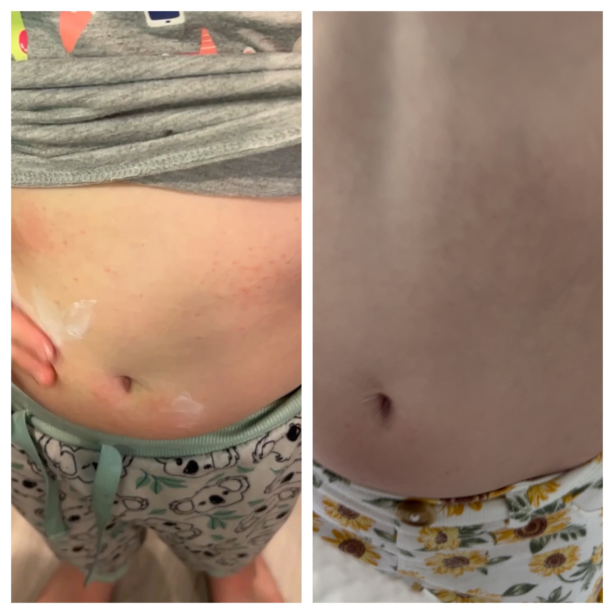 Lifesaver for rashes, shocked this worked so well and the NEXT DAY this rash was GONE. She was in pool very next day no issues 🙏🏼. I linked exact one we used, they have other sizes but not sure if it’s same formula. 

#LTKbaby #LTKkids