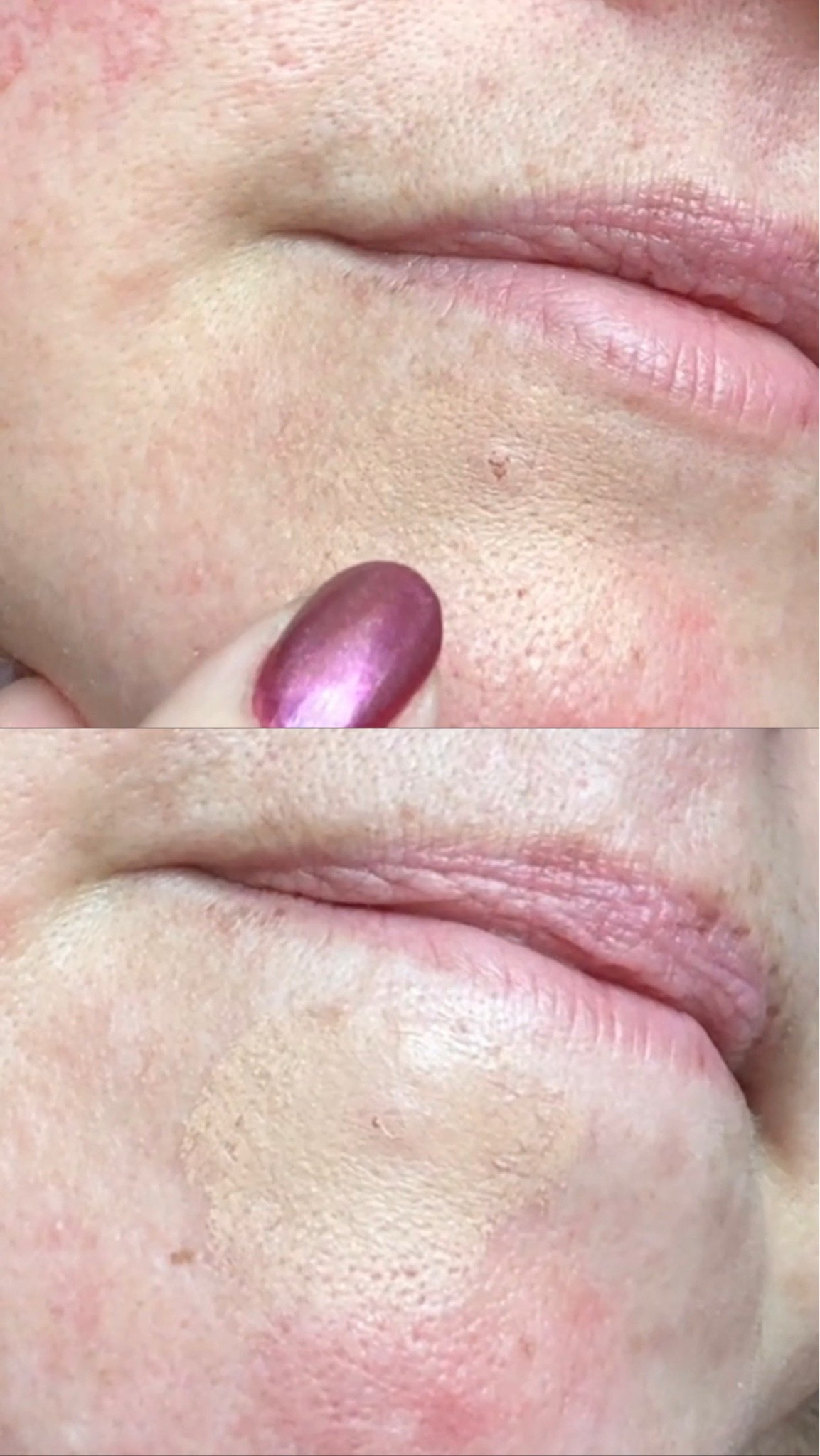 Love the results of this hero mighty shield! It makes my zit look way less noticeable with makeup on top.

#LTKBeauty #LTKmorningroutine #LTKdayinmylife