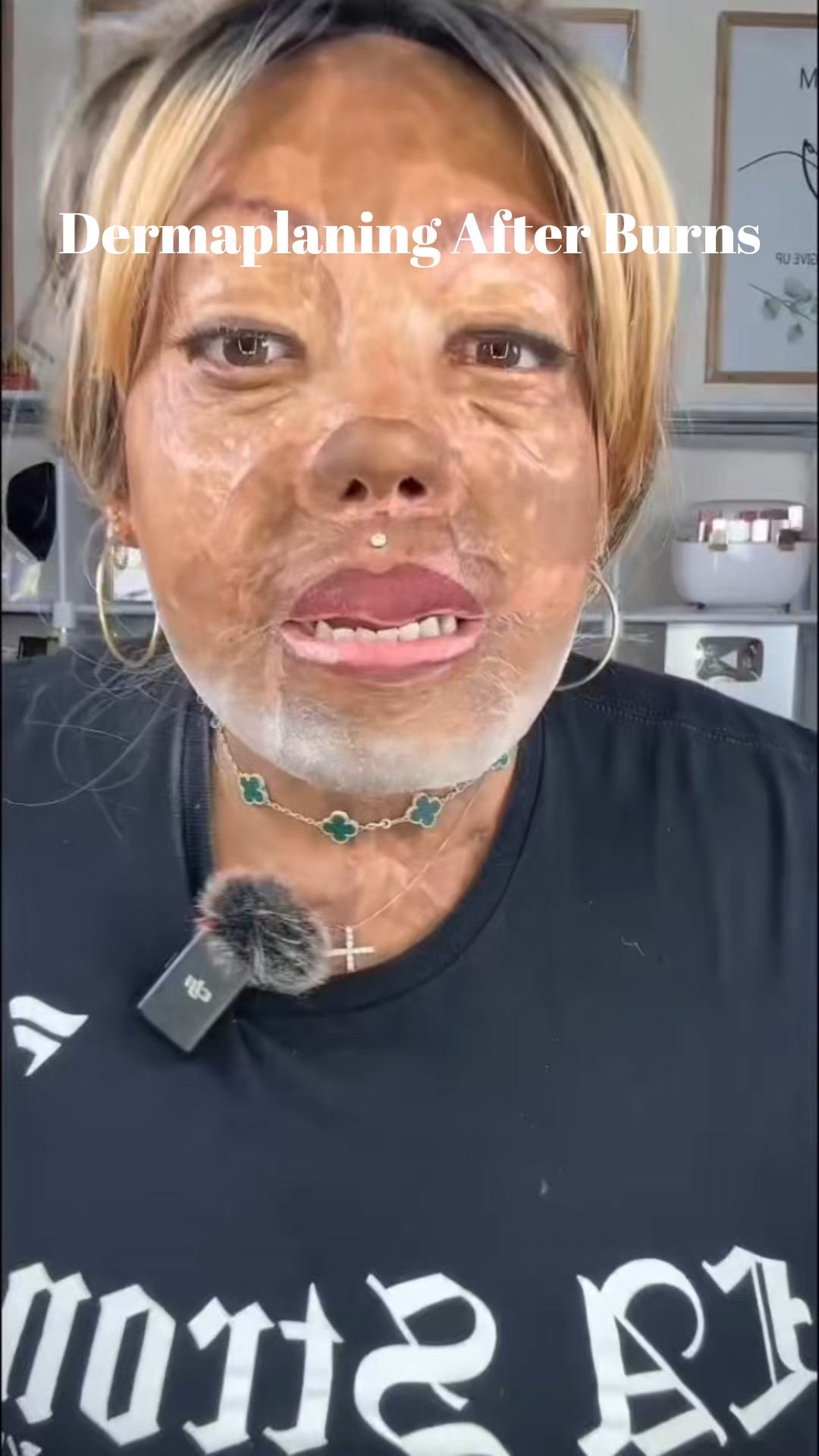 @SKNBODY Hair Identifier Spray & Dermaplaner Set is perfect for those hard to see hairs and peach fuzz on your face.

I loved how soft my face felt from the derma plane and from the skin care included in the spray!

I also tagged my @alliesofskin skin care regimen that I used off camera.

Love y’all!😘

#skincareroutine #dermaplaning #burnsurvivor #healingjourney #sknbody

#LTKOver40 #LTKBeauty