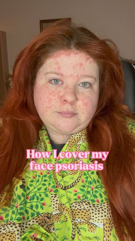 How to cover face psoriasis  


#LTKbeauty