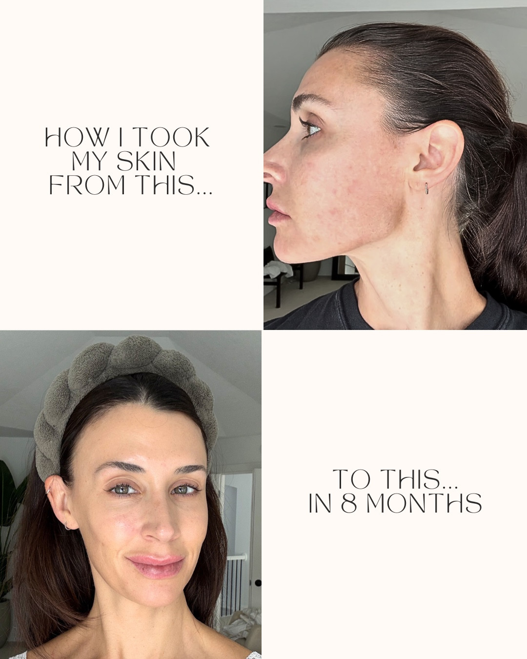 Everything I’ve been doing to help my skin over the last 8 months! Results have been strong! Korean skincare, attention to cleanliness, skin supplements, in office collagen boosters, and red light therapy! 

#LTKBeauty #LTKselfcare #LTKdayinmylife