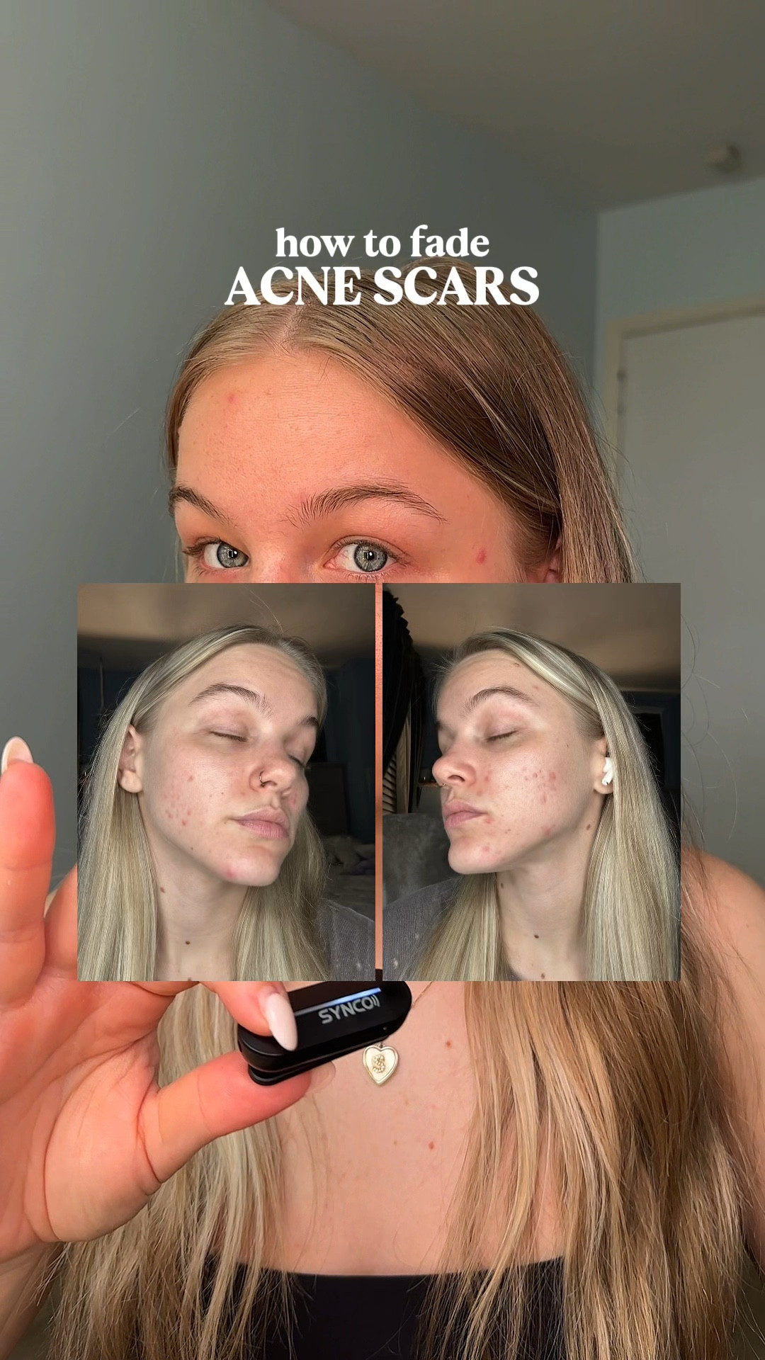 acne scar, dark spot, & hyperpigmentation must-have ingredients/treatments/products! ⭐️

#LTKFindsUnder50 #LTKBeauty #LTKU