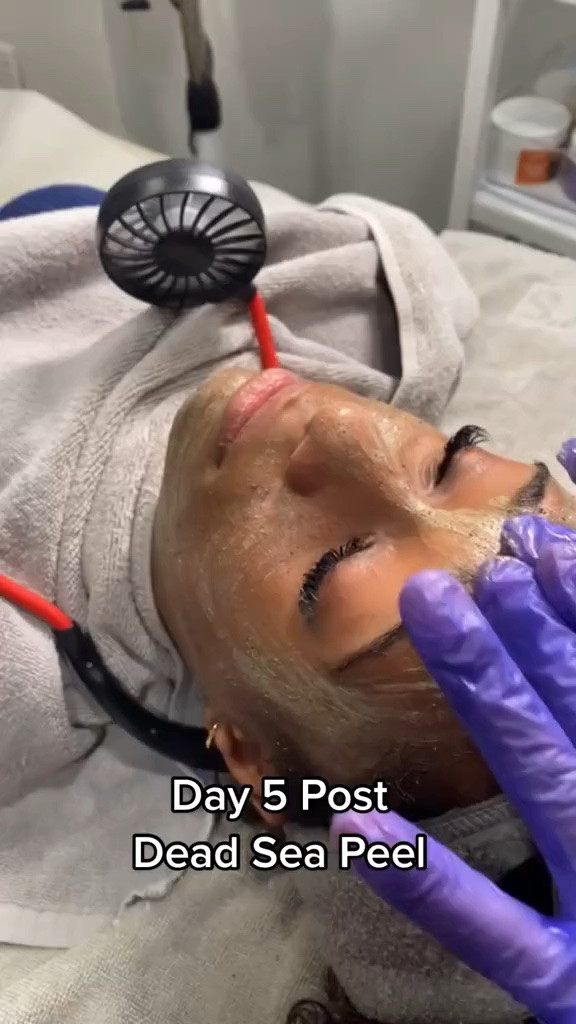 day 5 post Dead Sea peel! I peeled in two layers #chemicalpeel #esthetician #littletreat  #girlhood