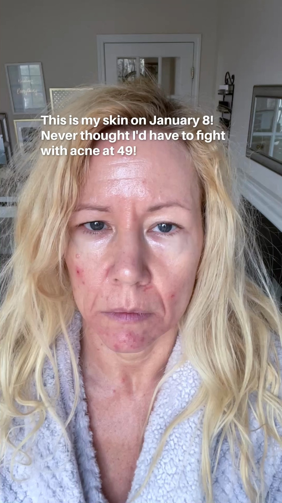 #giftedbyMurad UPDATE ON MY ACNE STORY! So as many of you know I am fighting with acne as a 49 year old woman. It was pretty bad y’all and got worse by the day! I had deep inflamed cystic acne that was super painful. So on January the 9th I decided to quit anything that could be the culprit: sugar, eggs, dairy and ALL SUPPLEMENTS (including protein shakes, collagen powder). Around that time I also stumbled on a thread on reddit about the Vital proteins collagen powder that caused for many women breakouts- especially on the chin area. This is exactly where I have the worst breakouts!

The craziest thing happened after I quit all my supplements! After around 3 weeks the acne moved to my neck and 2 weeks later I had acne on my belly! What? And then it slowly went away- just like that! After 8 weeks I have no cystic acne anymore. I just still have here and there some breakouts- but they are not that deep and inflamed anymore! I feel so relieved! I have re-introduced eggs to my diet and that does not seem to be an issue. So, in case any of you beautiful women also suffers from acne: do you take a collagen peptide powder? If so, this may be the culprit! I believe it was for me! 

A big thanks also to @Murad for sending me these acne products a couple of weeks ago when they heard about my acne story! That was so thoughtful! 

#LTKBeauty #LTKselfcare #LTKmorningroutine