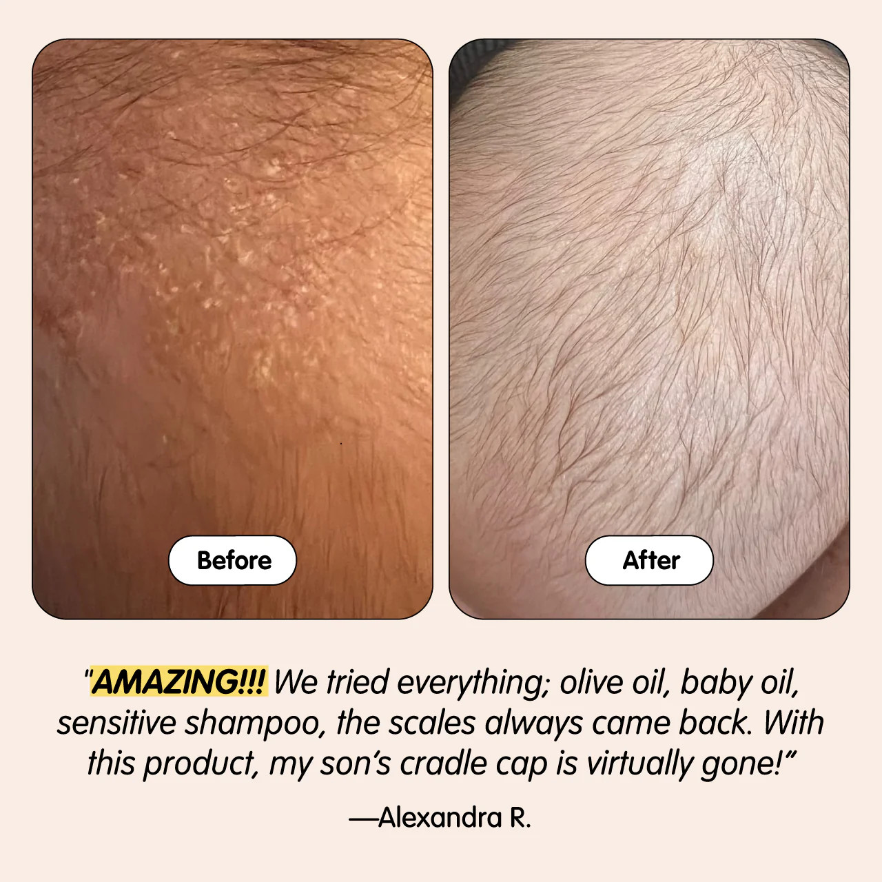 Bye-Bye Cradle Cap | Tubby Todd Bath Co.