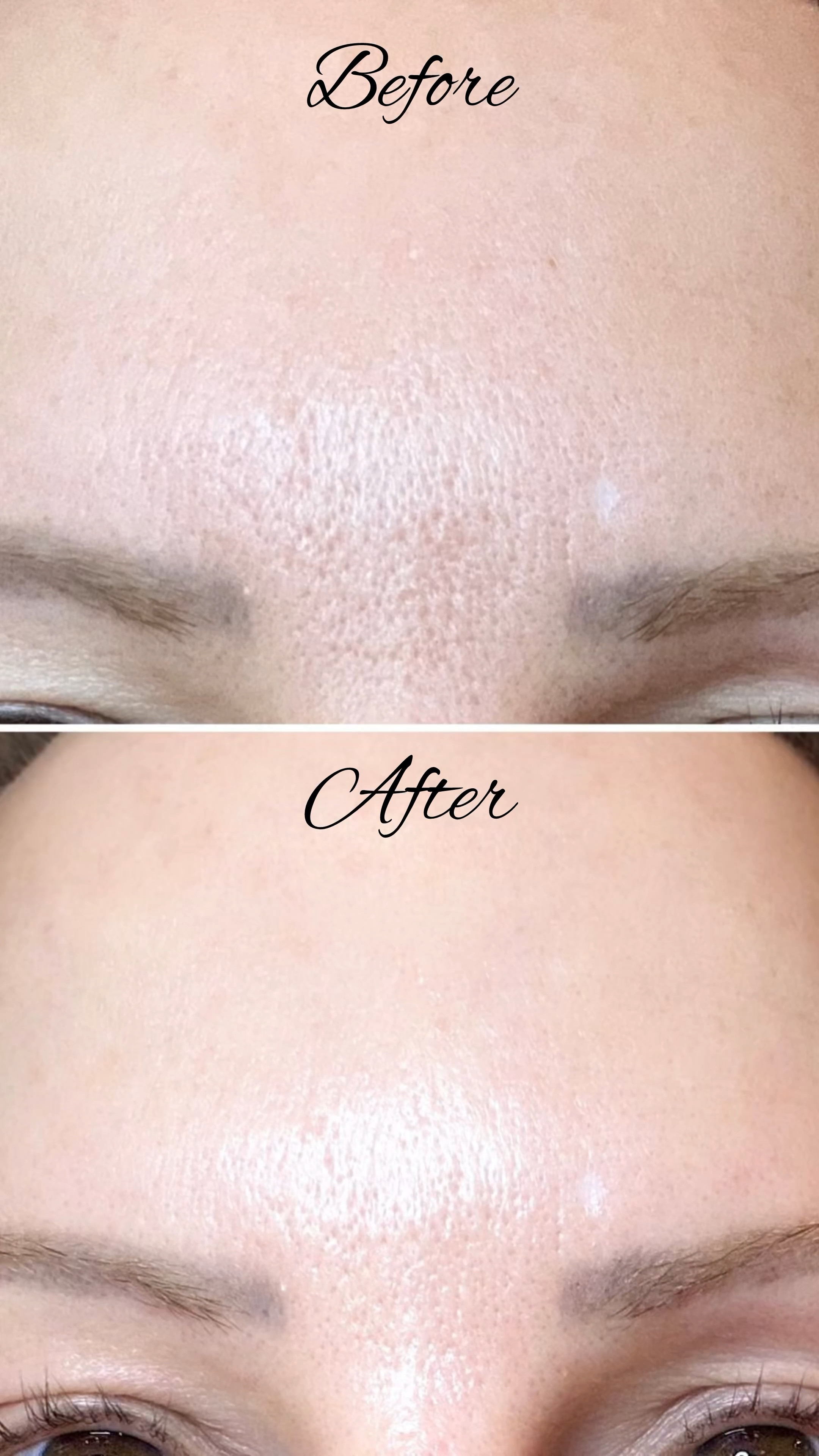 Before and after using Dr Diamond Metacine Instafacial® Plasma & Emulsion serum and cream luxury skincare duo. 

RESULTS: The biggest changes I saw were that my pores looked a lot smaller and less visible, improvement in overall skin tone and radiance, and that my skin color looked more even. BUT it’s not a miracle fix or face lift in a bottle but there are definite improvements. 

TIPS FOR USING: Don’t use a full pipette but just a few drops to make it last longer. I made the mistake of using a full dropper each time and it only lasted me 3 weeks whereas I still have plenty of emulsion left. In the morning I followed with SPF. In the evening I skipped night cream as I found it hydrating enough by itself. 

ABOUT METACINE: They were created by world renowned facial plastic surgeon, Dr. Jason Diamond to mimic the effects of the doctor’s celebrity favorite, in-office Instafacial procedure - a multimodality treatment that utilizes lasers, microneedling, and platelet rich plasma to stimulate cellular regeneration for a more radiant and flawless complexion.

FAQ’s
The plasma in the InstaFacial® Plasma is formulated with bioengineered human identical growth factors that stimulate platelet-rich plasma’s ability to support skin repair & rejuvenation.
Skip your vitamin c and serum and use the plasma instead.
Follow with SPF in the morning.

#skincare #drdiamond #instafacial #takeyourmetacine #drdiamondsmetacine #drdiamondwillseeyounow #dailydose #doctorsorders

#LTKOver40 #LTKVideo #LTKBeauty