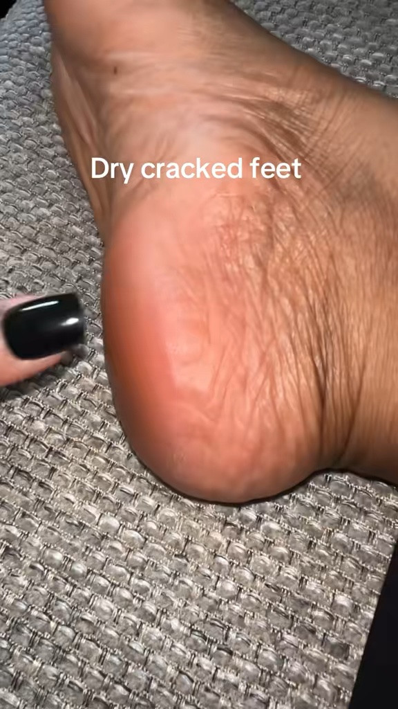 Foot care for dry cracked heels

#LTKselfcare #LTKmomlife #LTKBeauty