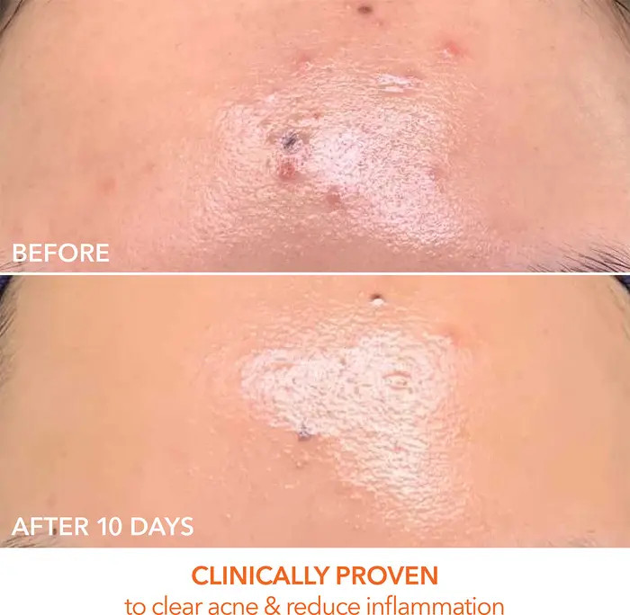 DRx SpectraLite™ FaceWare Pro LED Light Therapy Device | Nordstrom