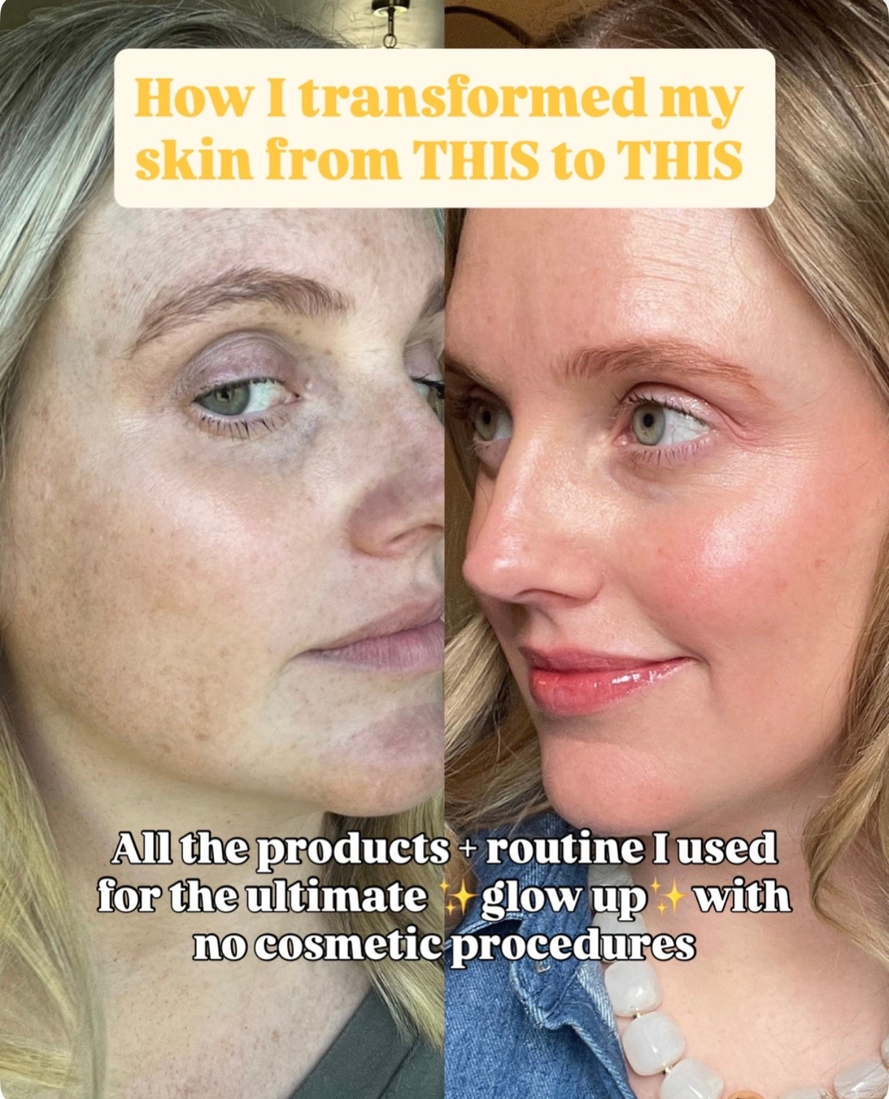 The skincare routine that transformed my skin! For reference I struggle with sensitive skin, rosacea, melasma, sun spots. Even if you choose to do cosmetic procedures you are throwing money away

* if you don't have a routine. Let me know if youhave any skincare questions below too in the comments and I'll try to answer them!

Easy skincare routine
Skincare steps
Melasma
Sun spots skincare
Home skincare
Order to apply skincare Skincare for sun spots Skincare for melasma

#LTKselfcare #LTKBeauty #LTKmorningroutine