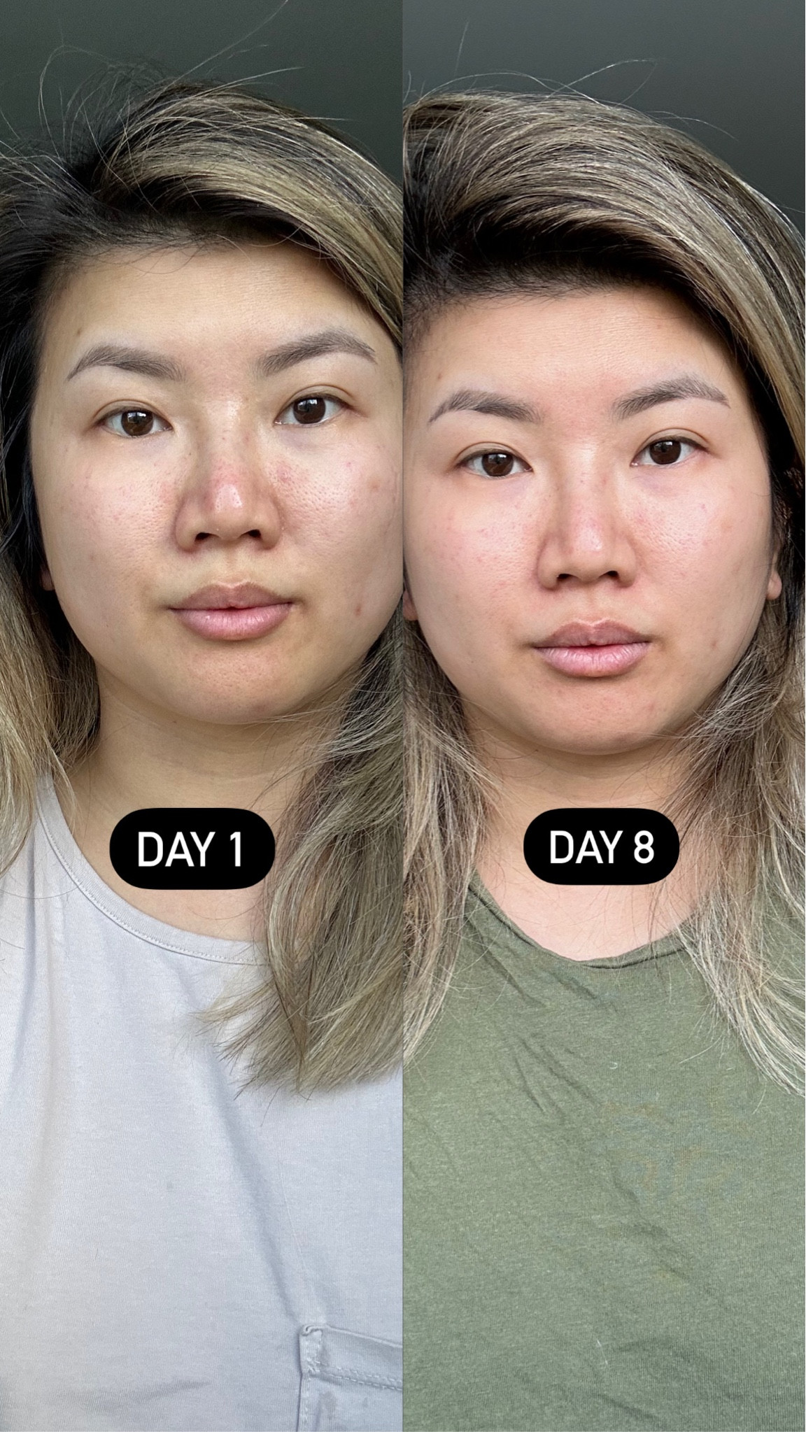 I’ve been trying the SKII essence for over a week and I’ve been taking progress pictures. I think it’s actually working and I’m quite impress with the progress in my skin so far! 

#LTKbeauty #LTKFind