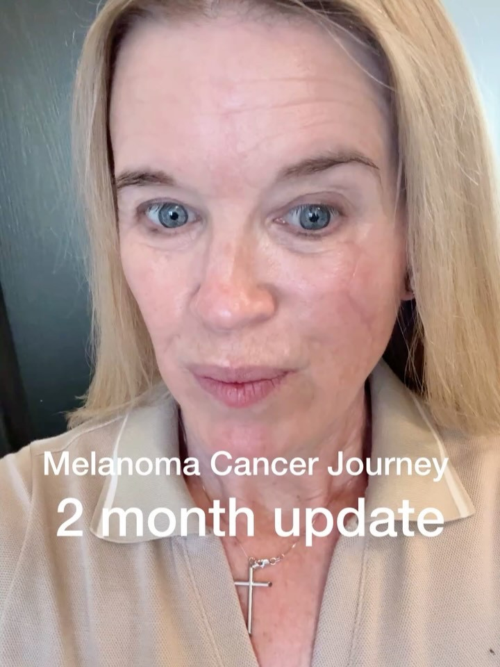 Melanoma Cancer Journey 
Part 5
Linked the Make up and skirt treatments I use and work


—2 month Update—

 1 month after my First laser treatment.

➡️Slide through the video clips and photos for ALL the updates➡️

I was diagnosed in December, Surgery in January and my first laser in February.

I’ve been sharing this Journey in hopes to help encourage you to make a skin check up appointment. 

Melanoma Cancer is deadly and very different from Skin Cancer.

Melanoma cancer is deadly,  early detection is key, before it can spread to lymph nodes, organs blood. 

If your new here or just seeing this post, I have 4 other parts with all the info and my Journey to date in Feed and stores saved to highlights with more info.

Thank you for all the kind messages, comments and prayers! I appreciate you being apart of my tribe.

Thank you and NOW make your Skin Appointment!

#skincancerawareness #skincancer #melanoma

#LTKdayinmylife #LTKselfcare #LTKBeauty