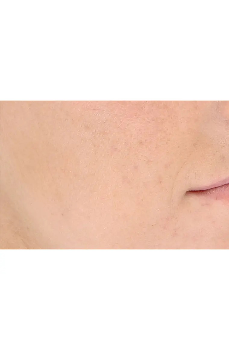 LightStim for Acne LED Light Therapy Device | Nordstrom