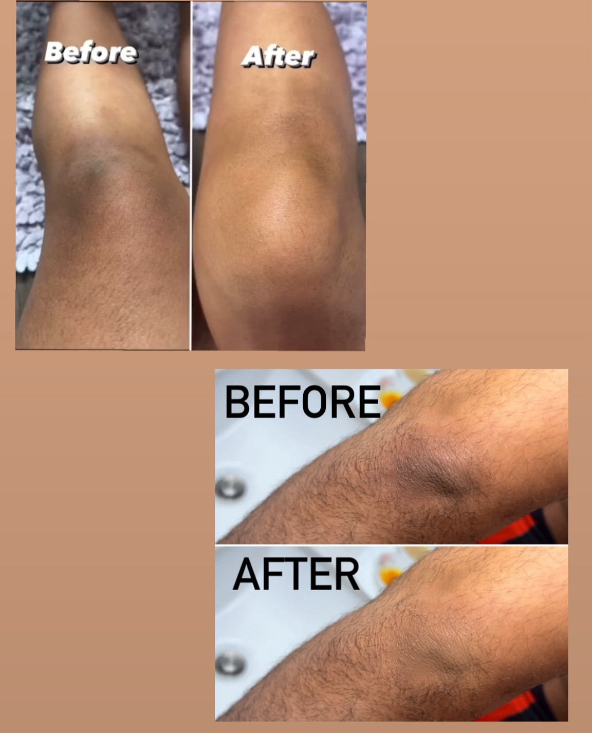 
Top Lotions and Oils for Lightening Dark Knees and Elbows: Effective Solutions for Even Skin Tone

Achieving an even skin tone on areas like knees and elbows can be challenging due to their tendency to darken. Here are some of the best lotions and oils that can help lighten these areas and promote a more uniform complexion:

	1.	Vitamin C Serums and Creams: Known for their brightening properties, vitamin C products can help reduce dark spots and even out skin tone.
	2.	Glycolic Acid Lotions: This alpha-hydroxy acid gently exfoliates the skin, promoting cell turnover and reducing pigmentation.
	3.	Retinol Creams: Retinol stimulates cell renewal and collagen production, helping to lighten dark areas and smooth the skin.
	4.	Kojic Acid Lotions: Derived from fungi, kojic acid is effective in inhibiting melanin production, making it a popular choice for skin lightening.
	5.	Licorice Extract Creams: Licorice extract is a natural skin lightener that helps fade dark spots and even out skin tone.
	6.	Coconut Oil: Rich in fatty acids, coconut oil moisturizes and can gradually improve skin tone with regular use.
	7.	Almond Oil: Packed with vitamin E, almond oil helps nourish the skin and lighten dark areas.
	8.	Shea Butter: A highly moisturizing natural product that can help improve skin texture and tone over time.
	9.	Aloe Vera Gel: Known for its soothing and healing properties, aloe vera can help lighten hyperpigmented skin when used consistently.
