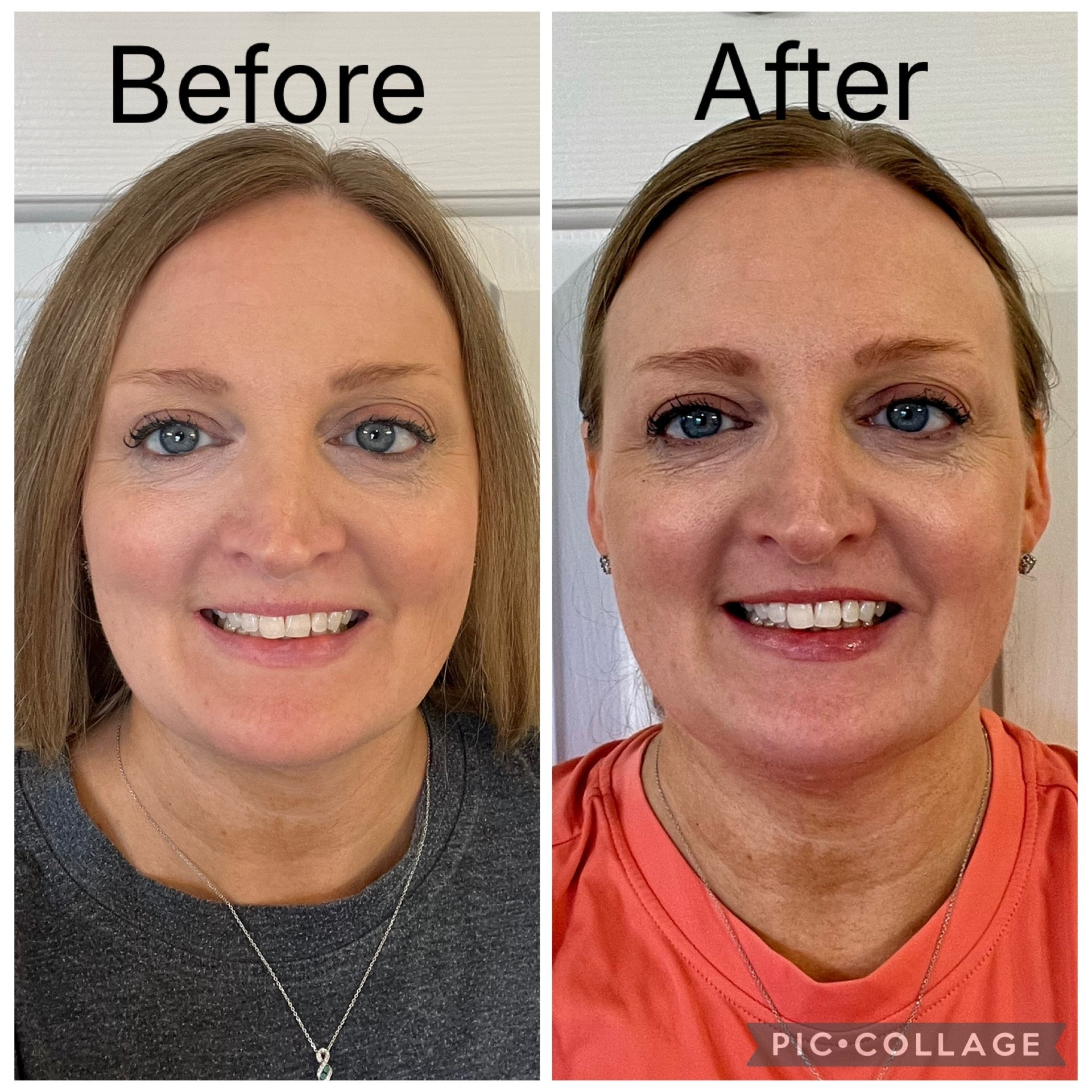 Before & After with one use of my collagen mask. I don’t see a difference yet but my skin certainly FEELS amazing. I’ll take another picture after a month.

#LTKOver40 #LTKselfcare #LTKmomlife