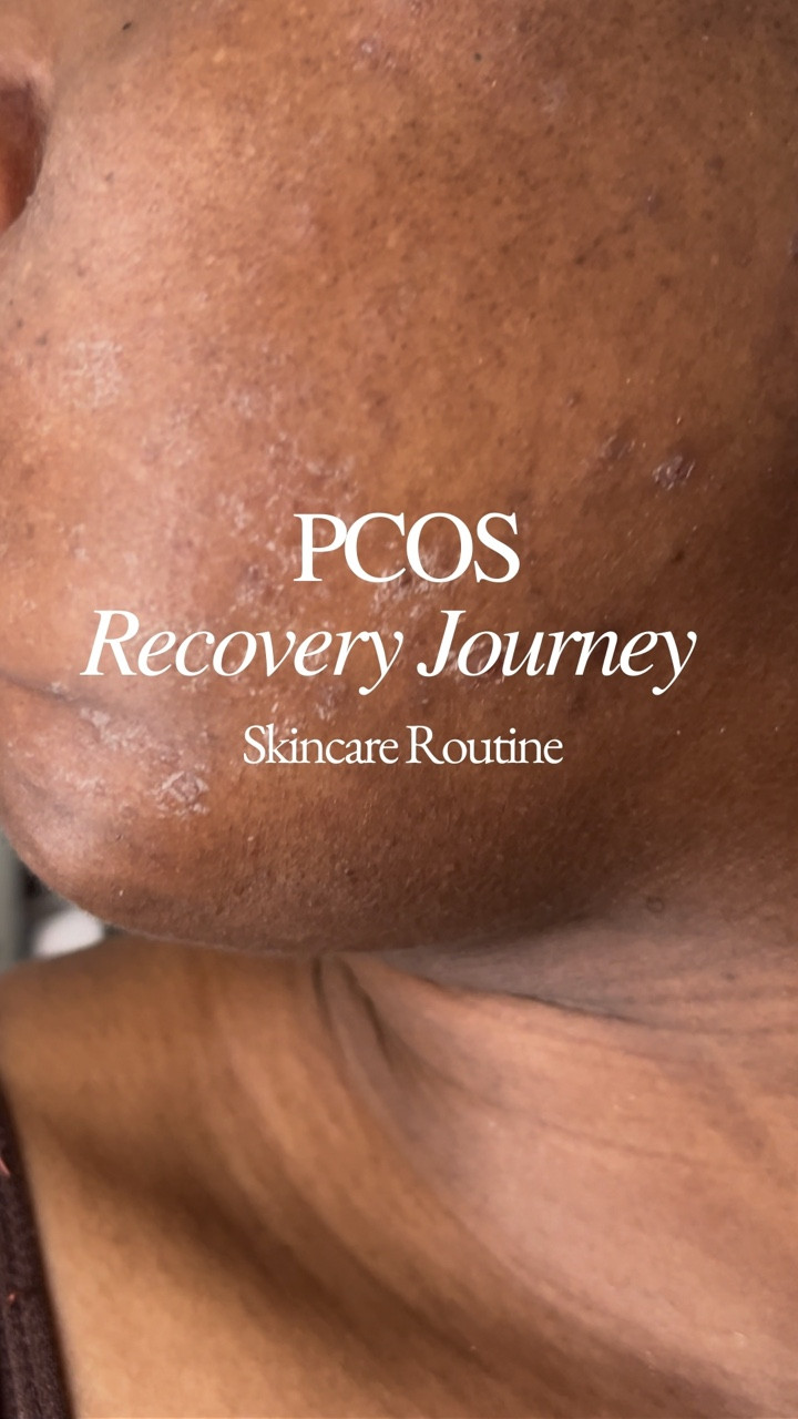 PCOS Skin Recovery Update 💕
Nobody told me that PCOS could do this… but it had its stiletto on my nekckk!

For years, you’ve witnessed me pour into myself through skincare and fall in love with a niche that (as an OG fashion stylist) I didn't expected to be in. I've grown and learned so much, and it has been a pivotal part of my positive well-being journey!

Products used:
- Green tea moist PHA gauze peeling @neogen_official 
- Real ferment micro essence 
- Real niacinamide serum 15% 
@neogen_official 
- Freeze tag ice roller @chasinrabbits.global 
- Beta Panthenol repair cream @somebymi.official_uk_ 
From @sokoglam at @spacenk 
- Lip oil essence @athletiabeauty_uk 
- Glazing mist @rhode @sephorauk 

#kbeautyskincare #skinfluencer #pcosacne @somebymi @athletiabeauty @tracepublicity @huntergracelondon

#LTKeurope #LTKuk #LTKbeauty