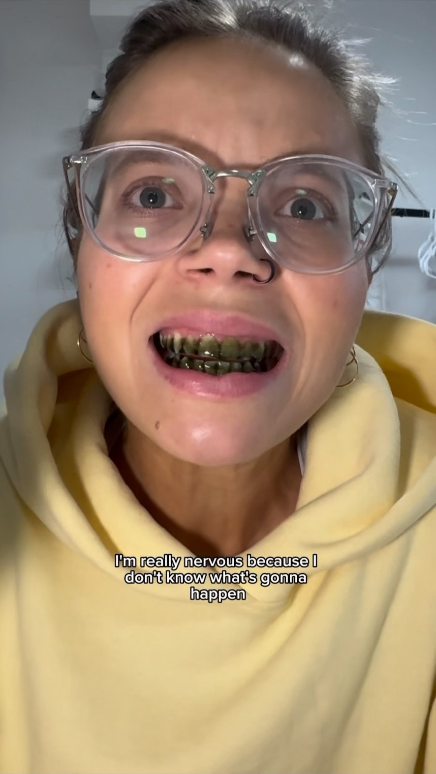 😂ANYWAYS, best whitening strips I’ve used yet!!!! #whiteningteeth #whiteningstrips #inopro #fyp #teeth 

#LTKcanada #LTKbeauty