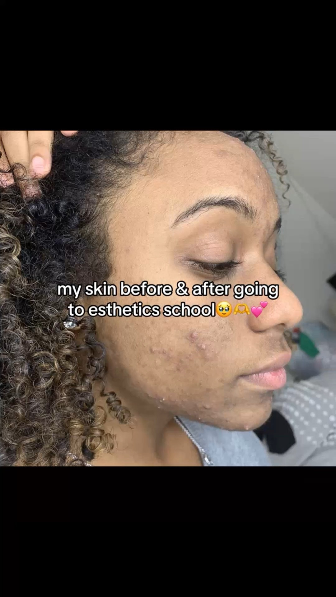 how i cleared my skin
i selfishly went to esthetics school because i wanted to understand how the skin works & fix it MYSELF instead of paying someone else to do it. i helped myself and now i get to help other people 🥹🫶💕 #esthetician #acne  #acnetreatment  #darkspots  #darkspottreatment